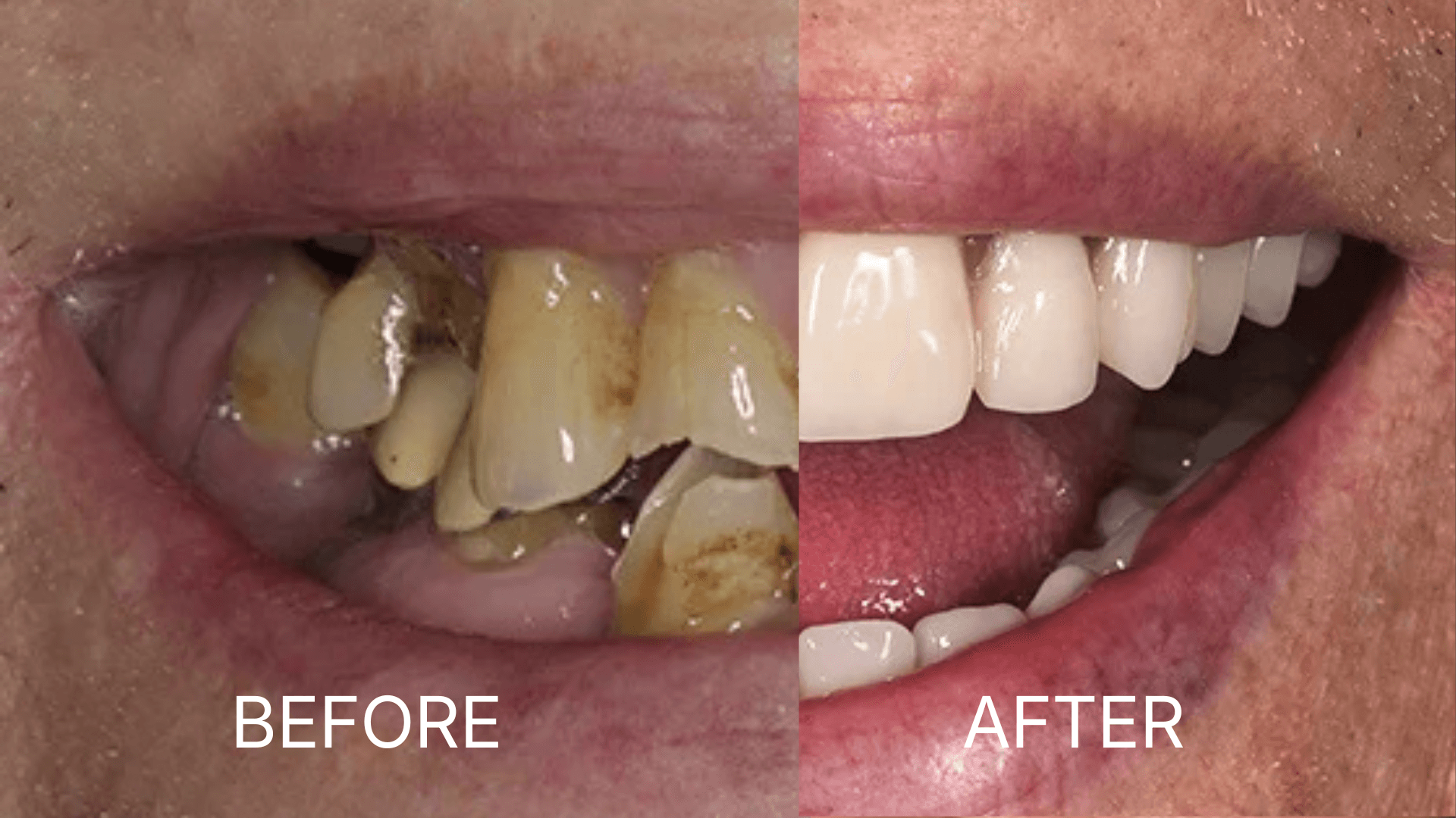 All-on-4 Dental Implants