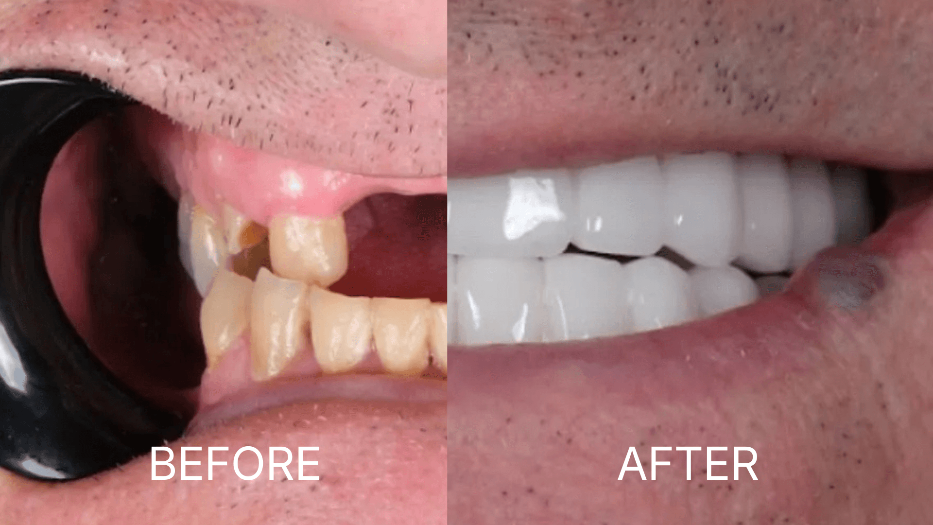 All-on-6 Dental Implants
