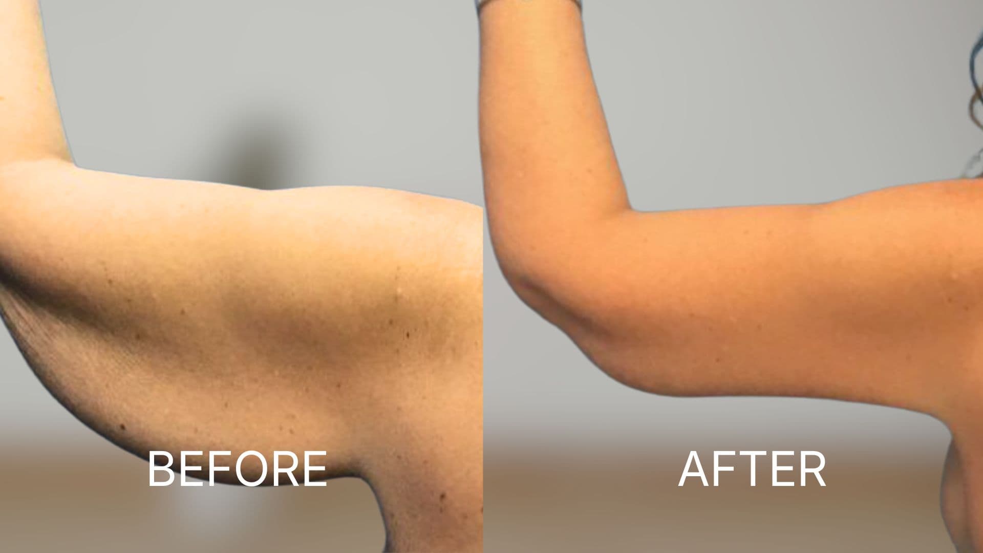 Arm Lift