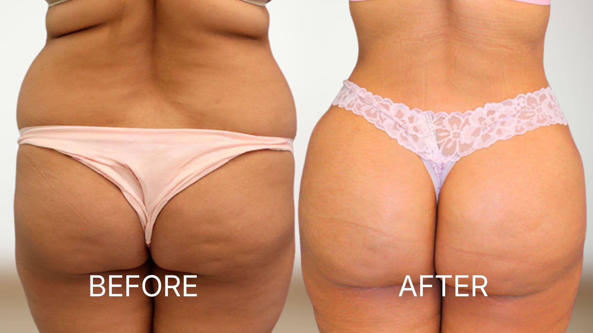 Brazilian Butt Lift (BBL)