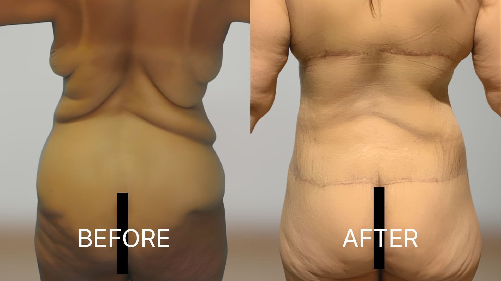Labiaplasty