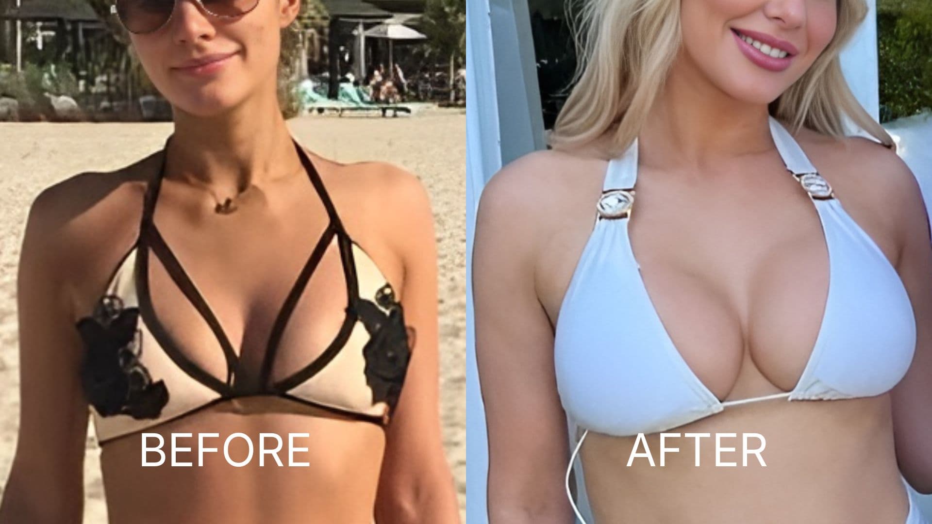 Breast Augmentation