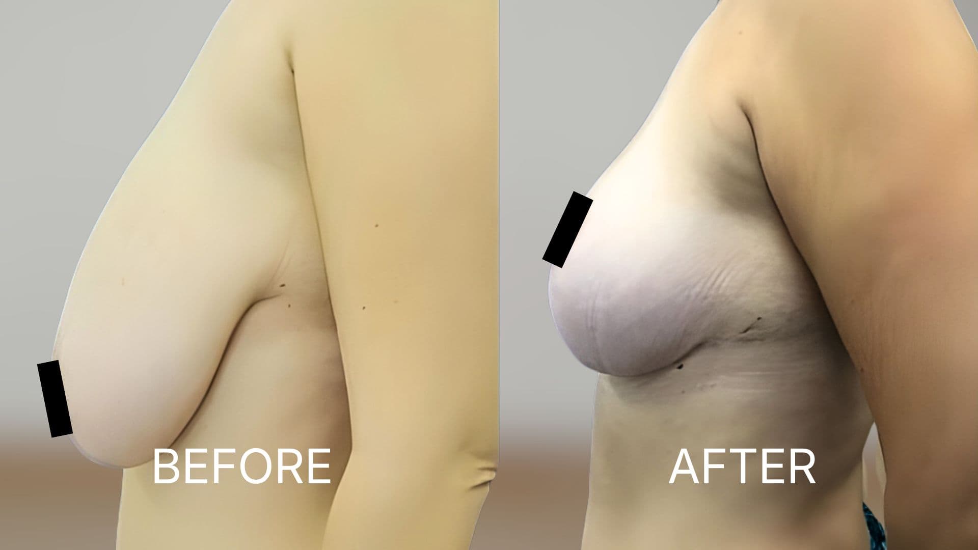 Breast Lift