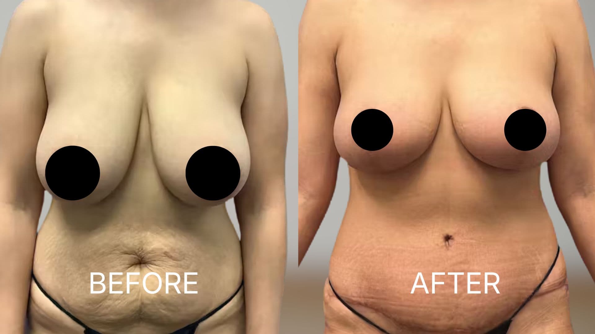 Breast Reduction