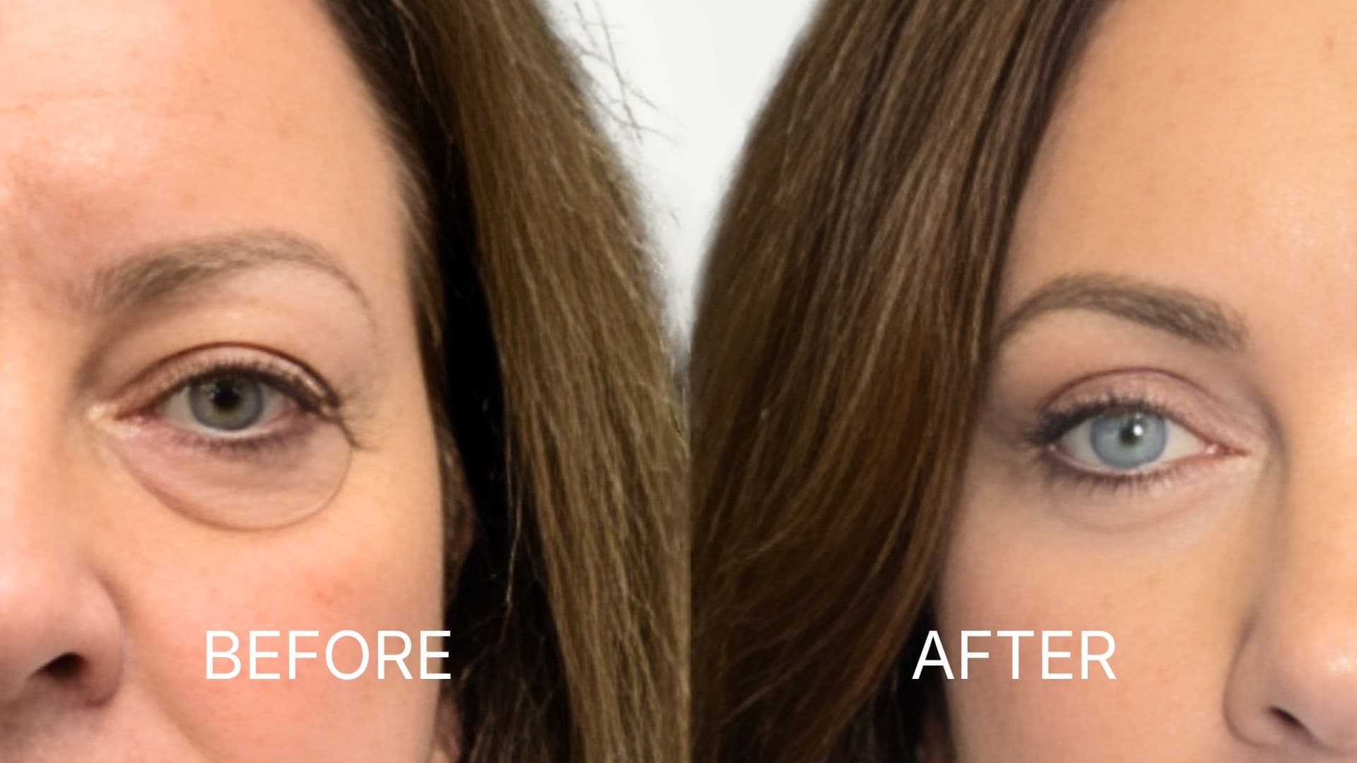 Brow Lift
