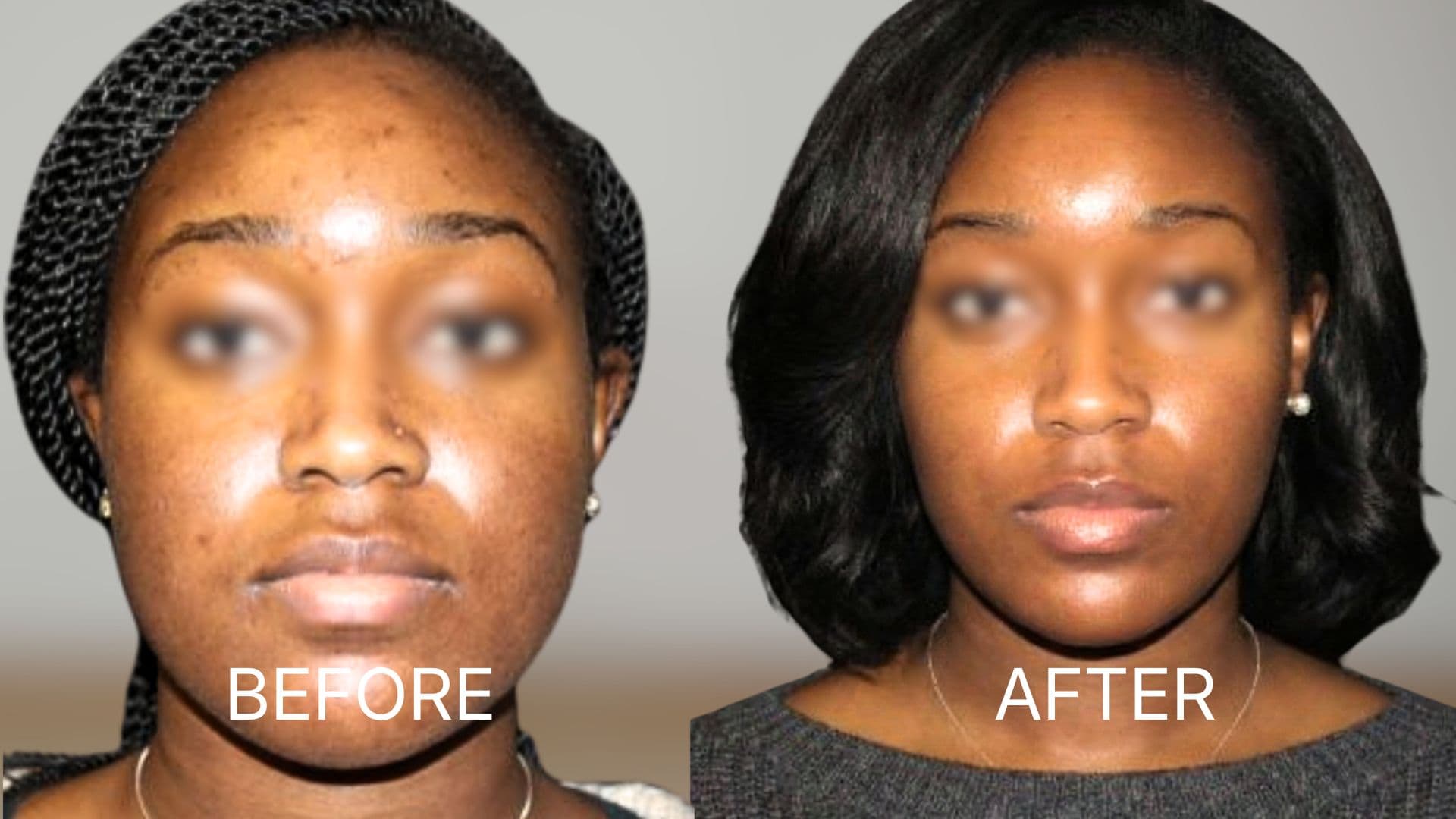 Buccal Fat Removal