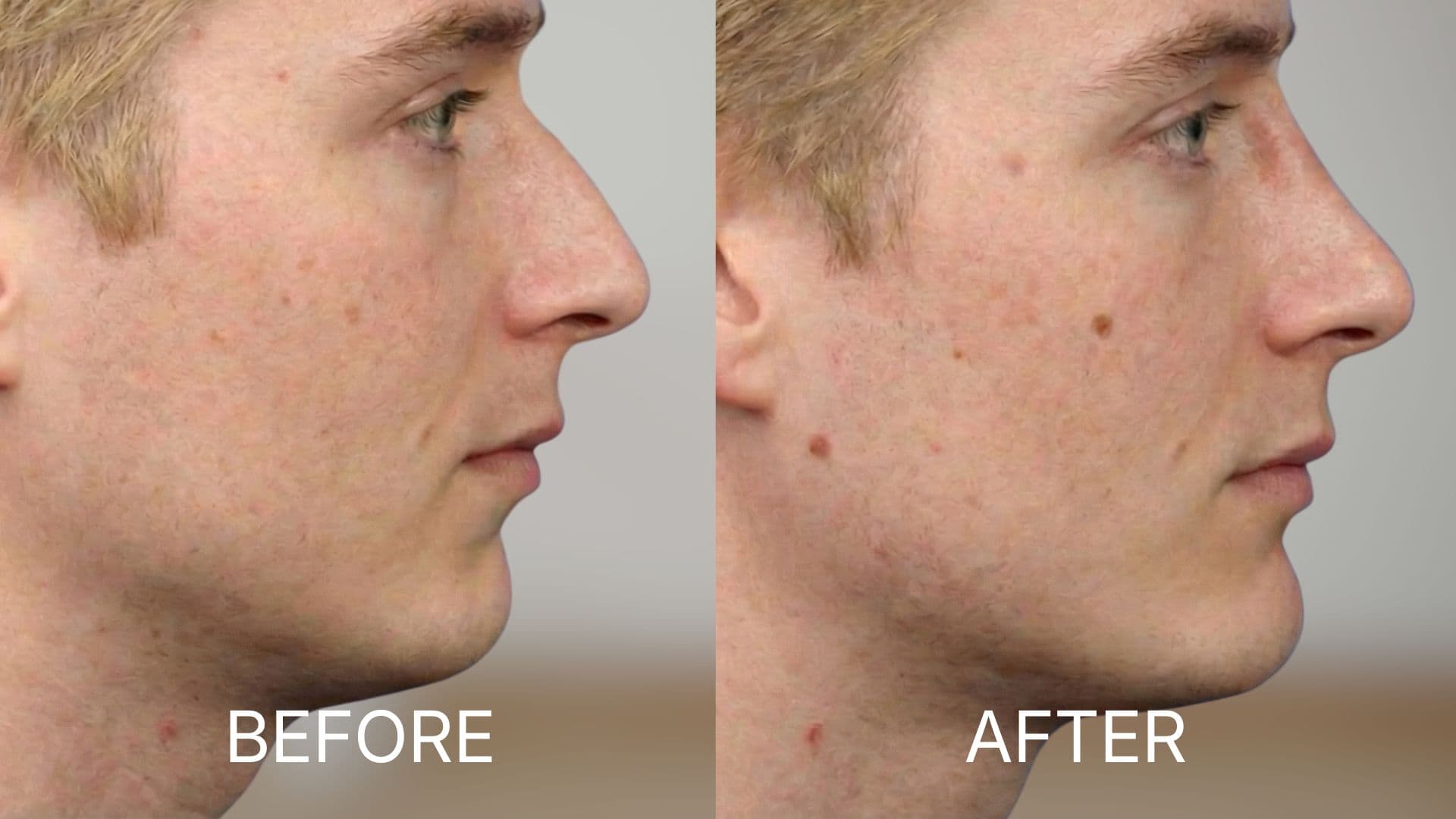 Chin Augmentation