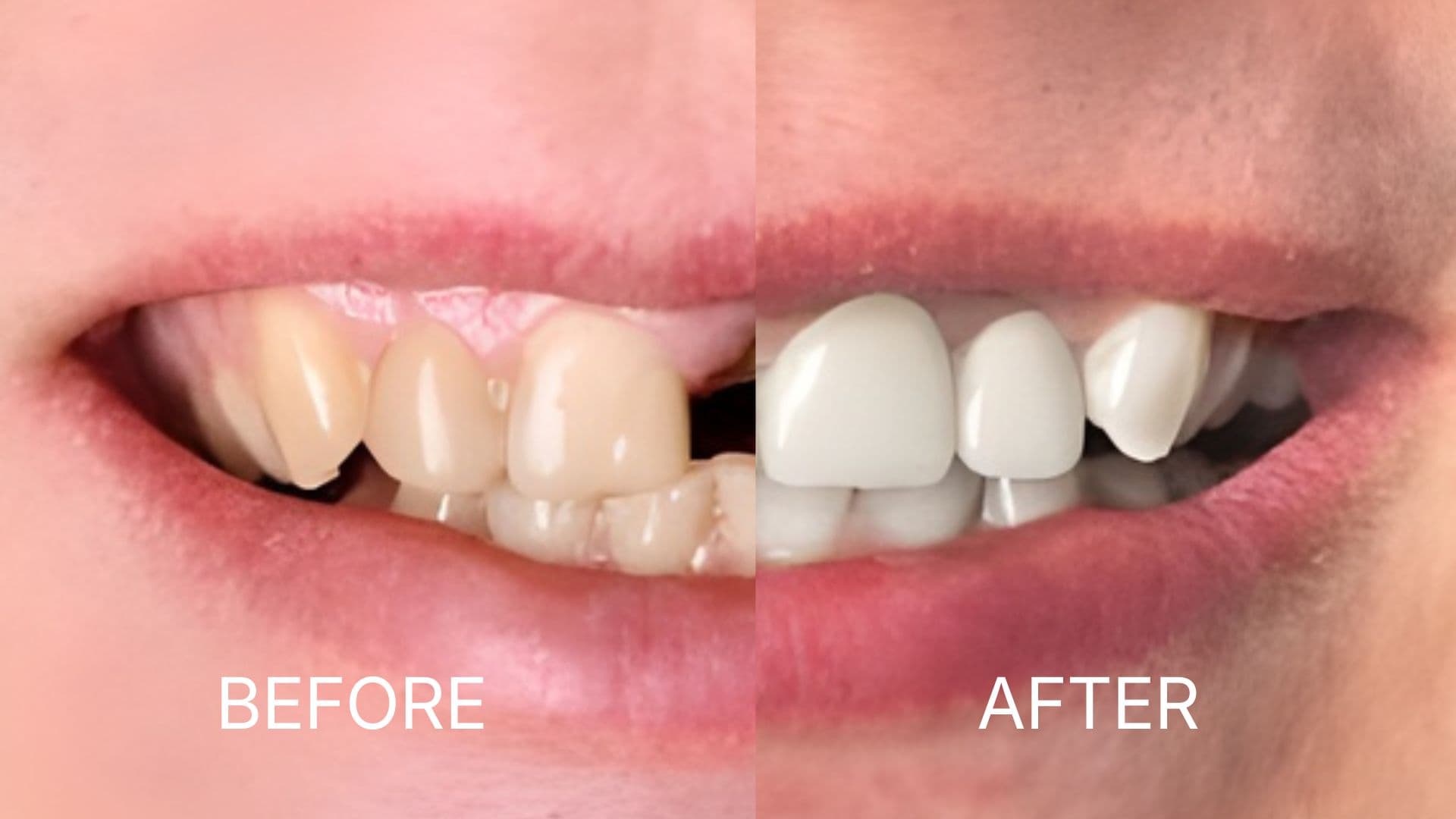 Dental Crowns