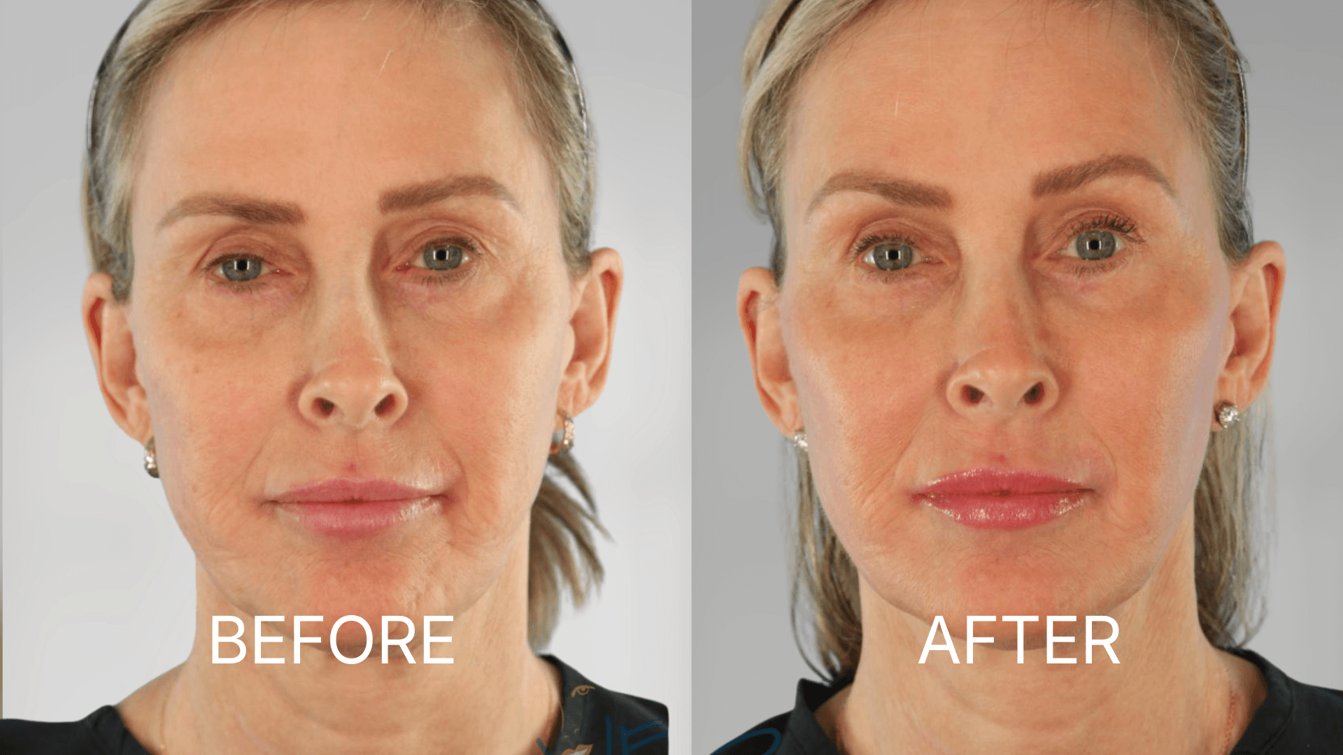 Dermal Fillers