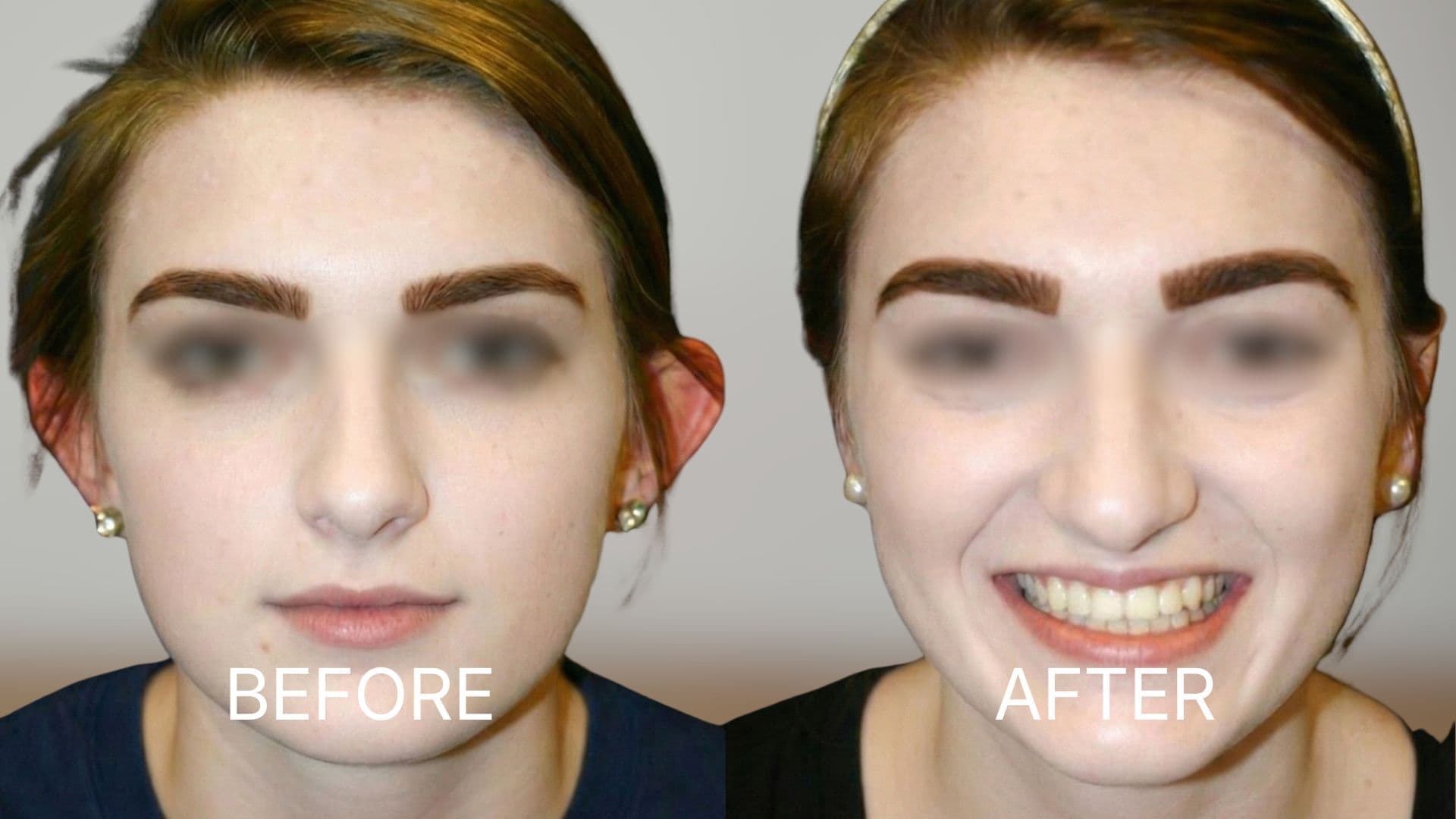 Ear Surgery (Otoplasty)