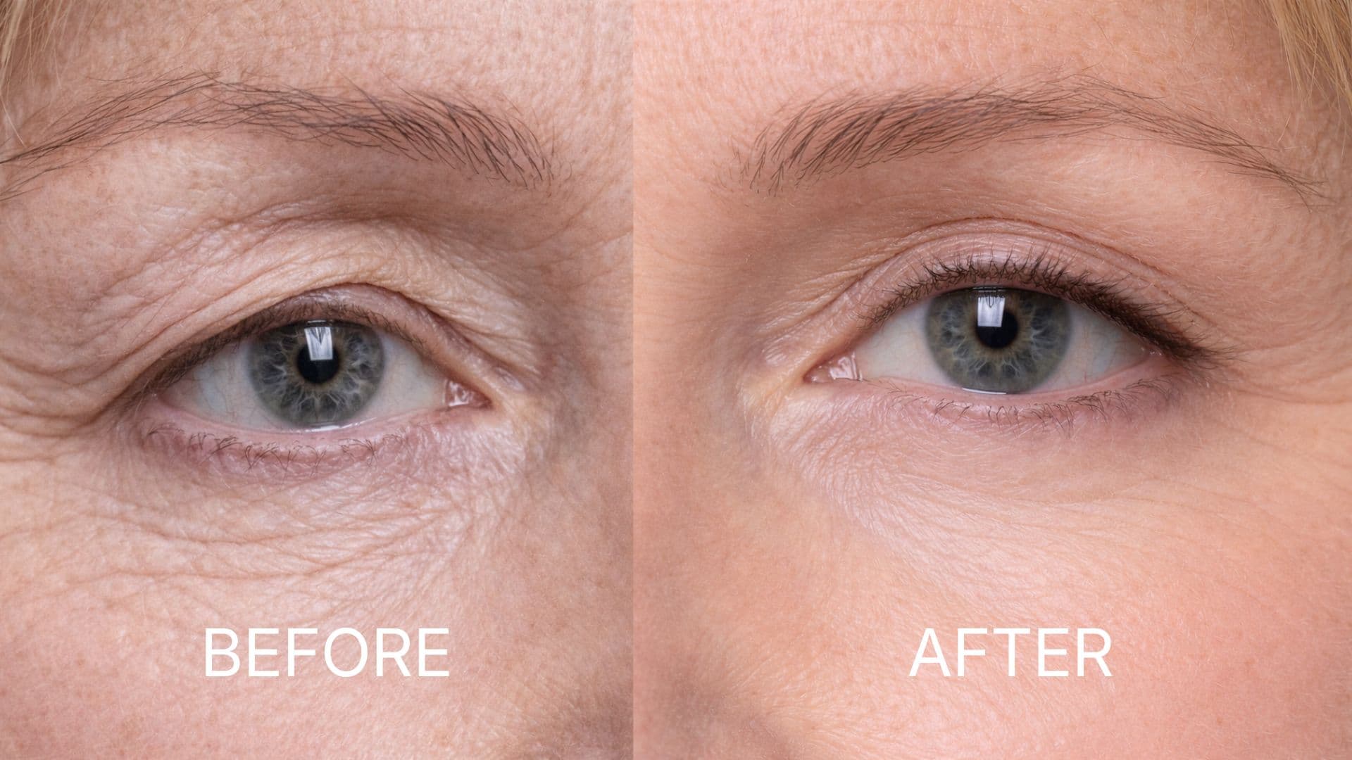 Eyelid Surgery