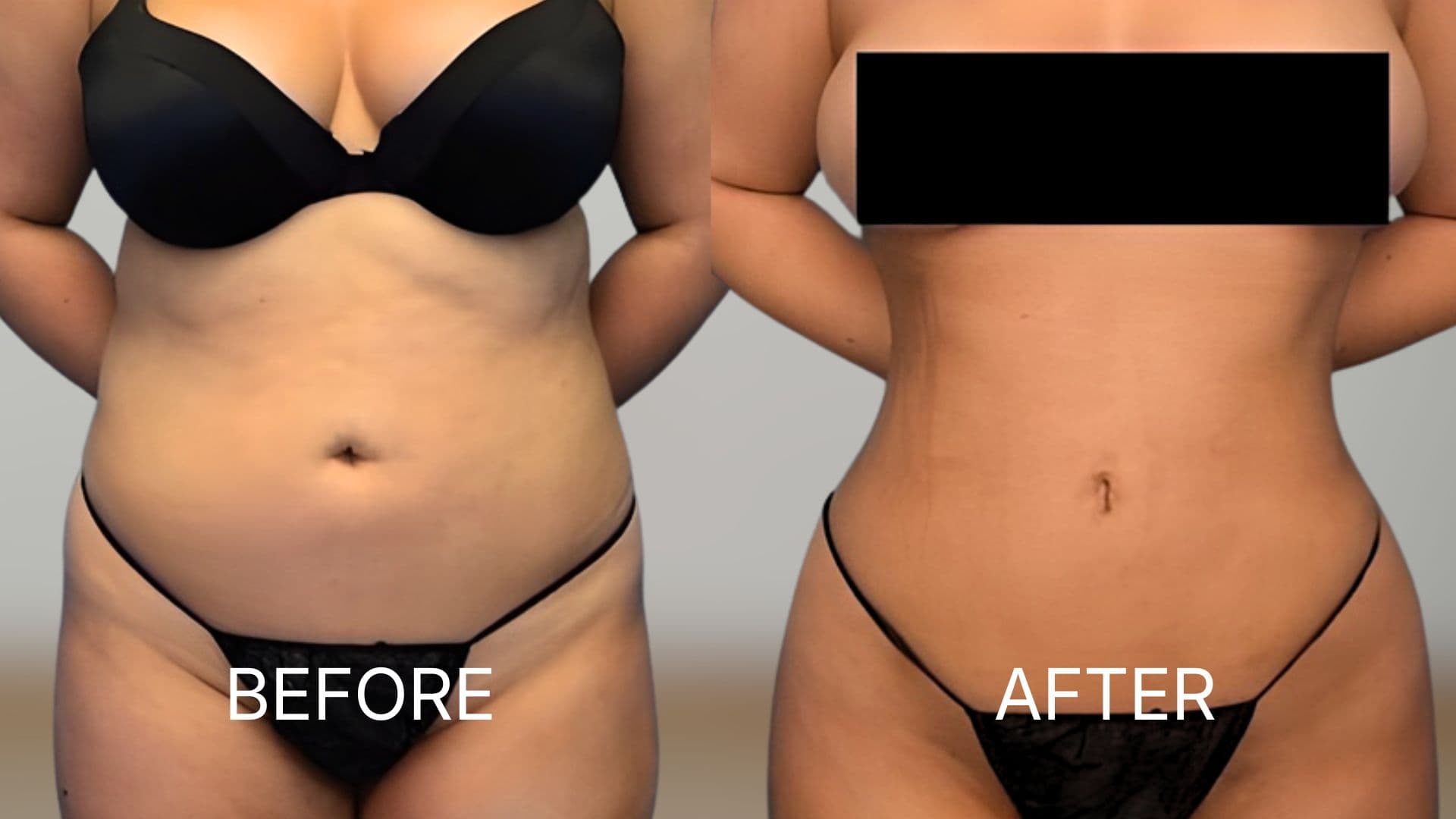 Fat Transfer