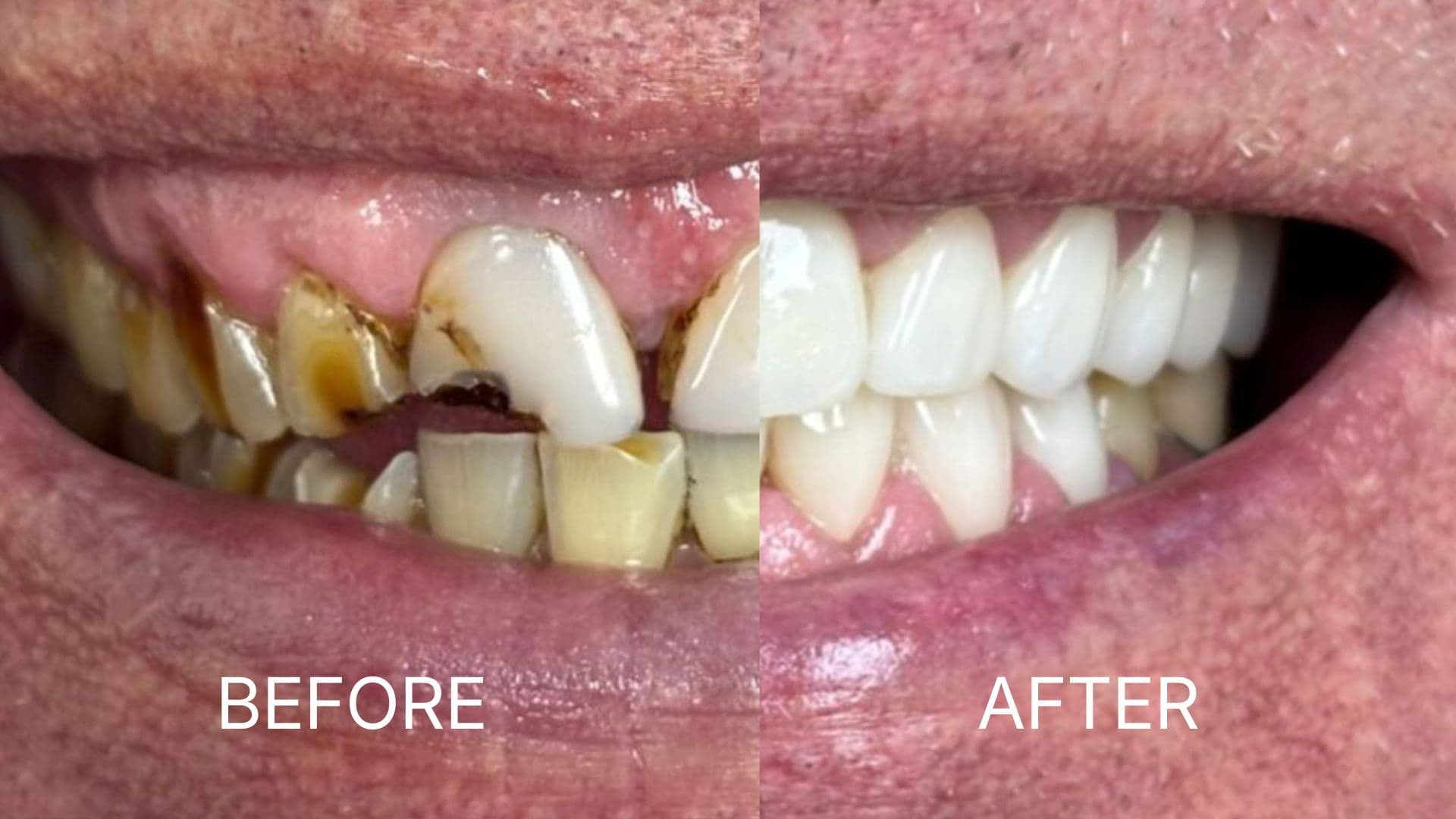 Full Mouth Restoration