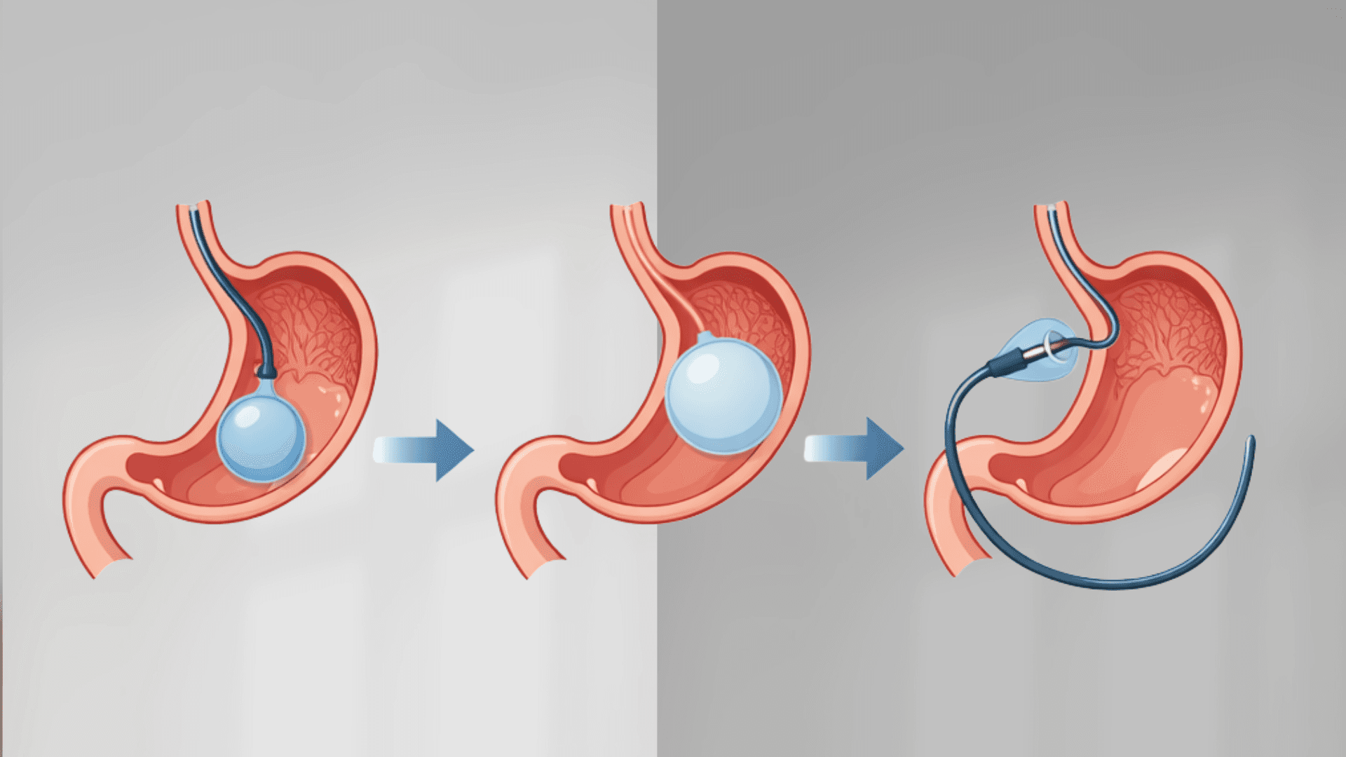 Gastric Balloon