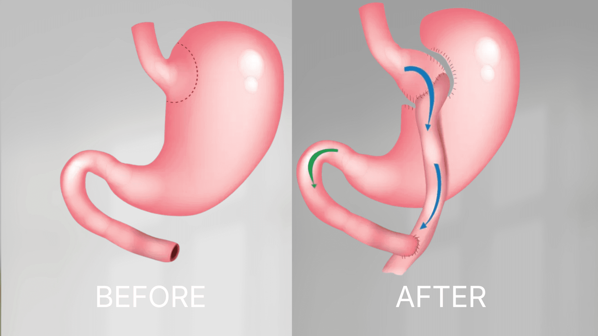 Gastric Bypass