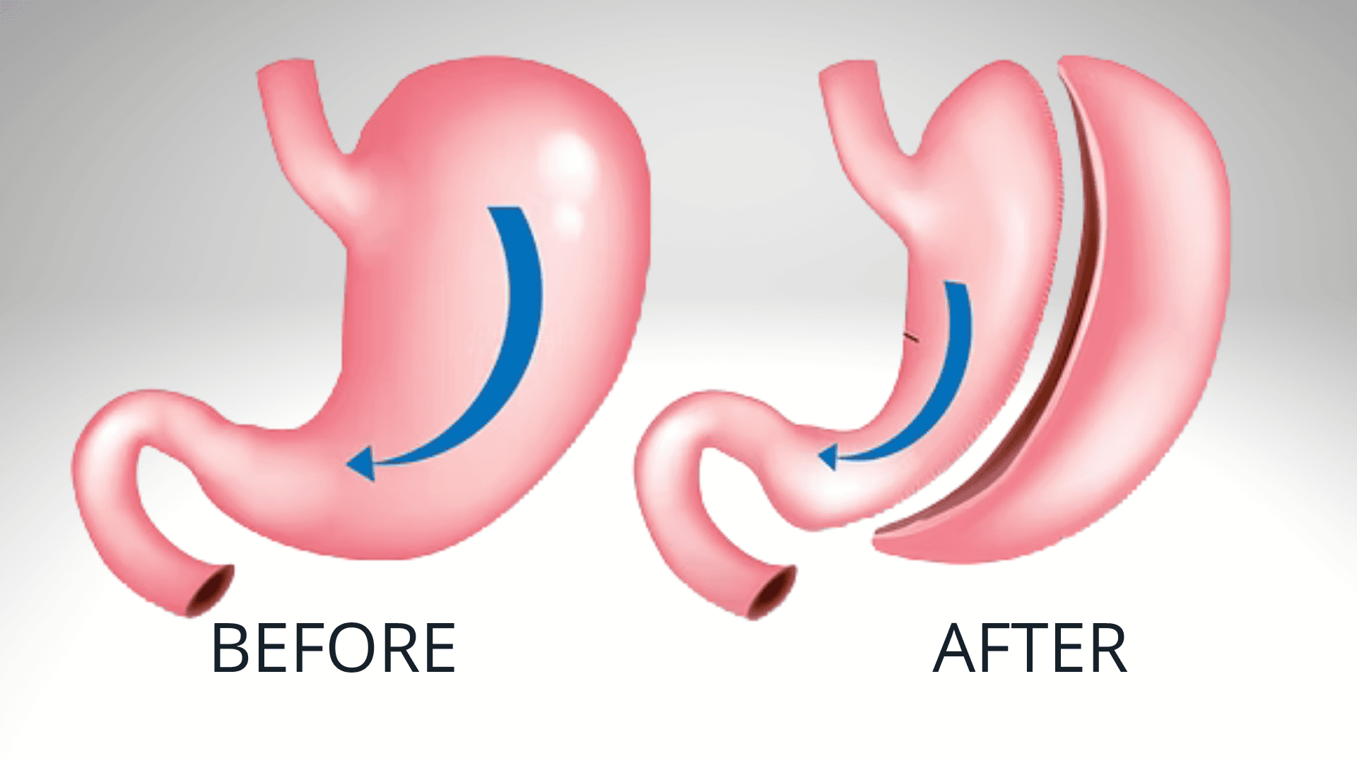 Gastric Sleeve