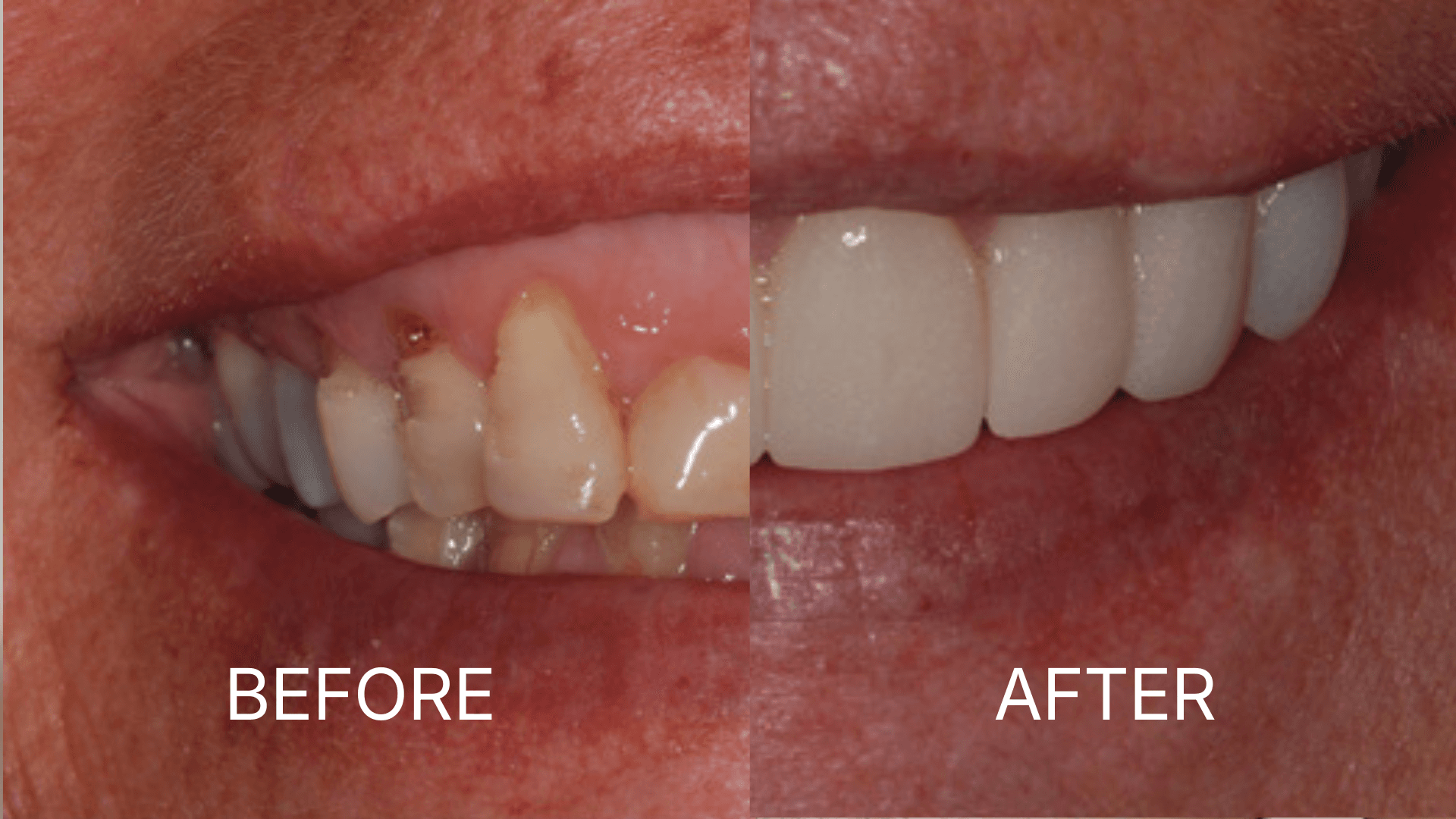 Gum Contouring