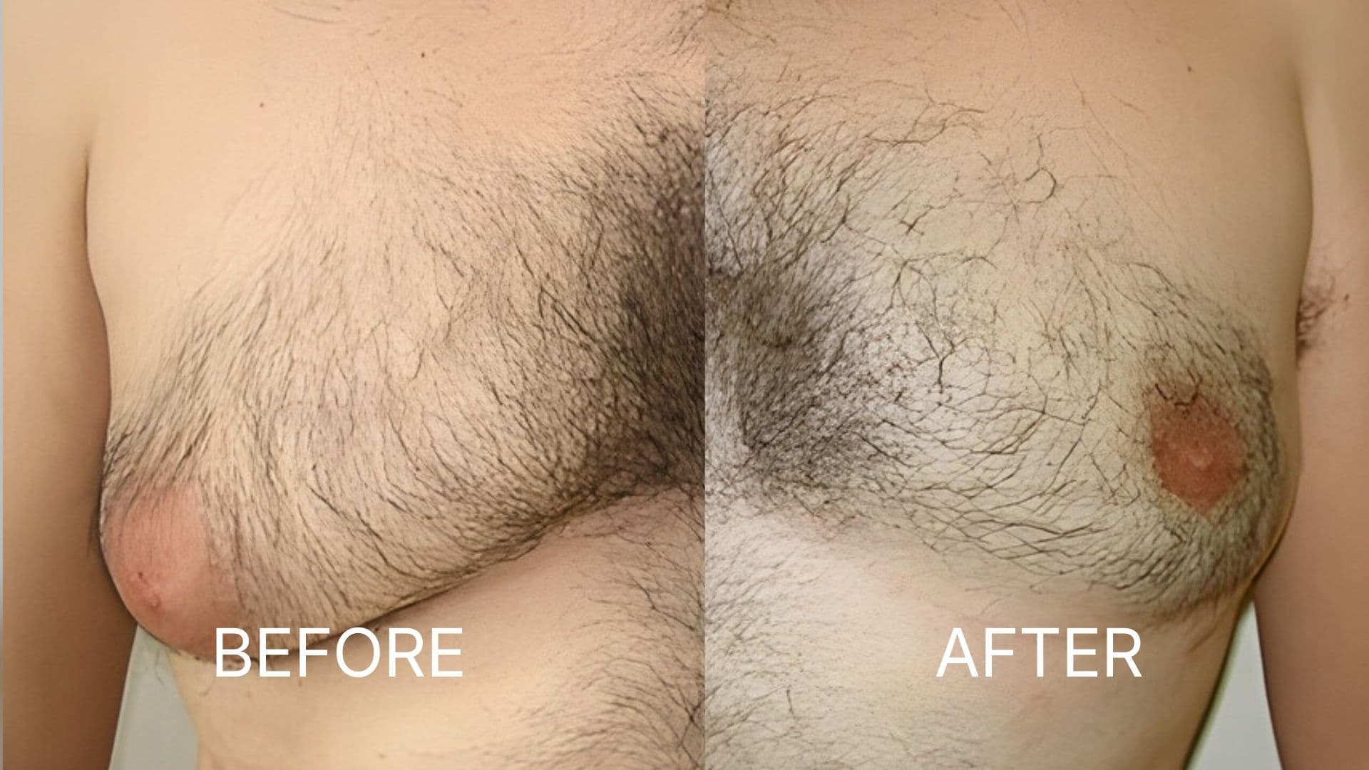 Gynecomastia Surgery
