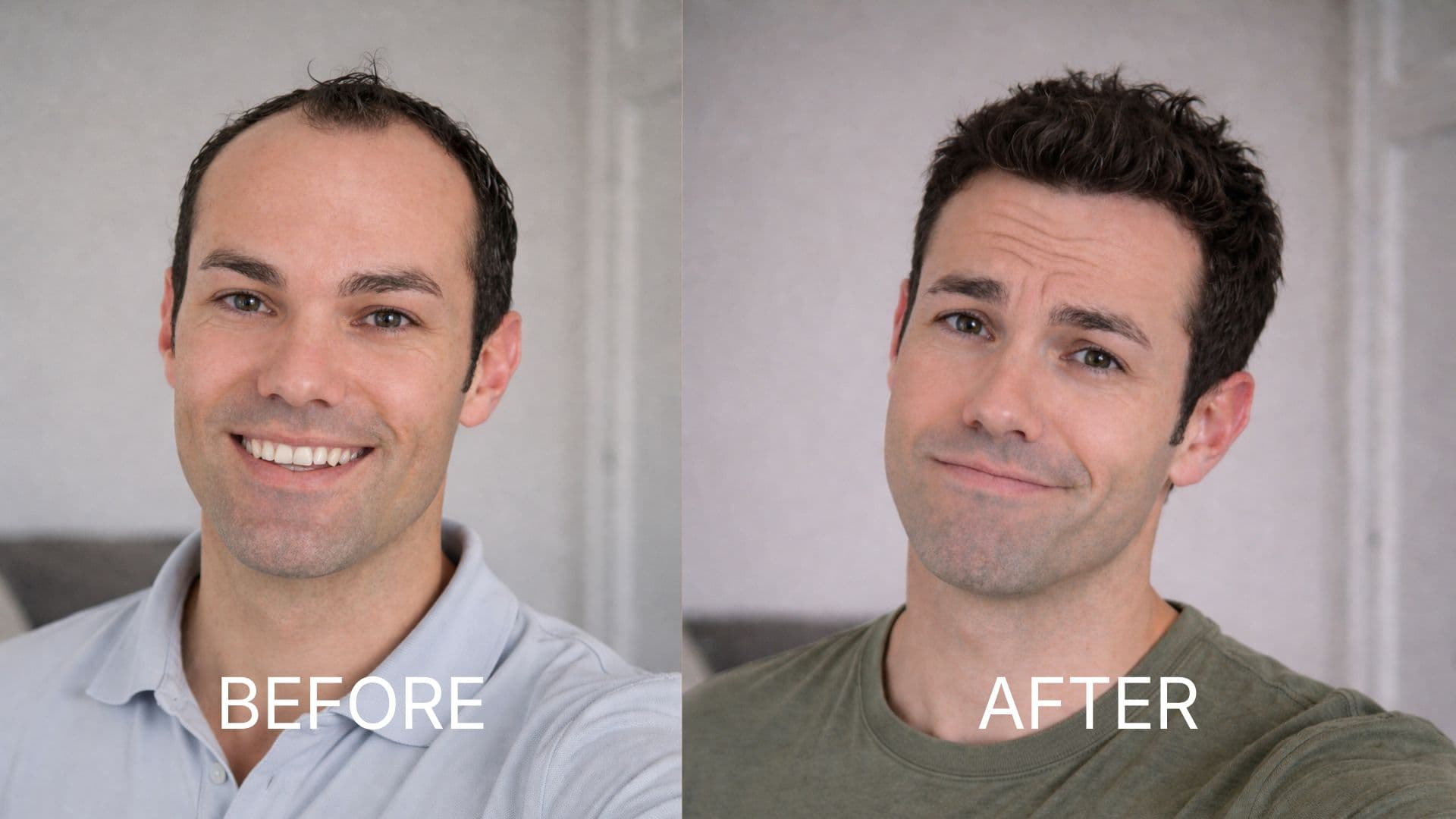 Hair Transplant