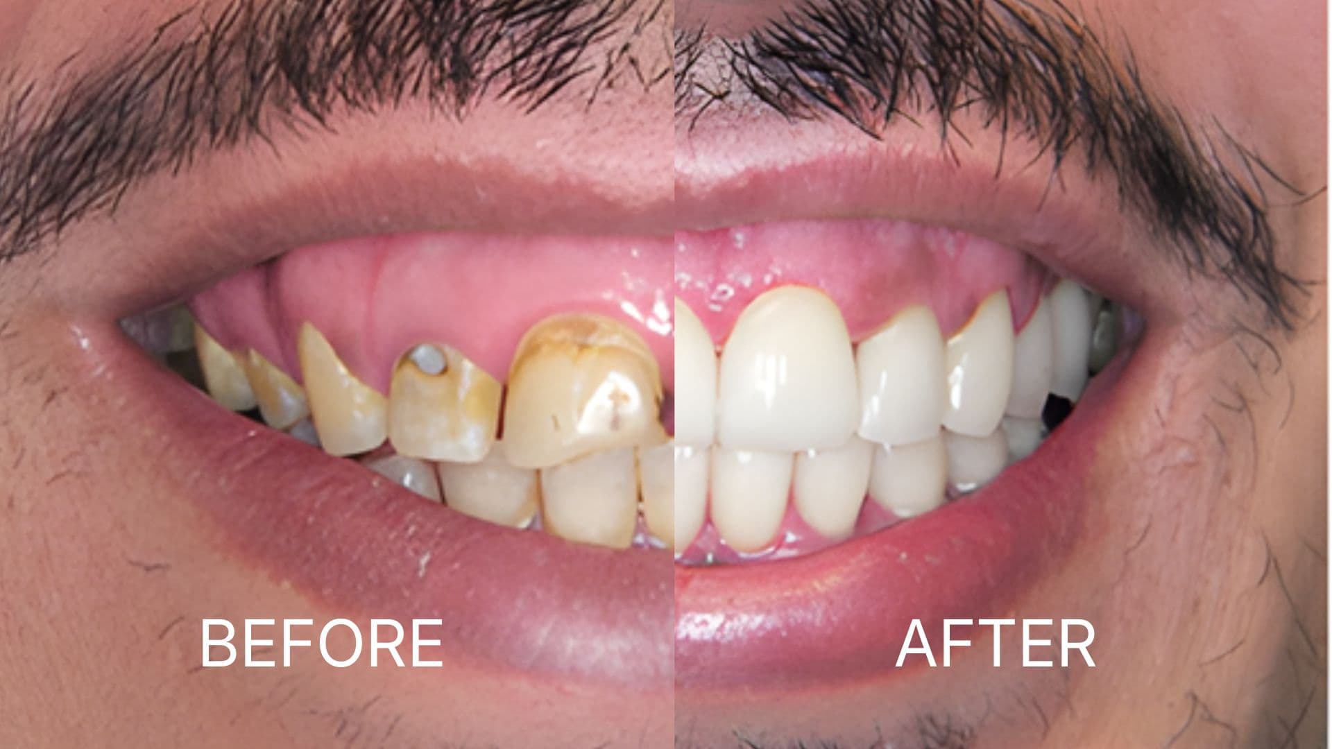 Hollywood Smile