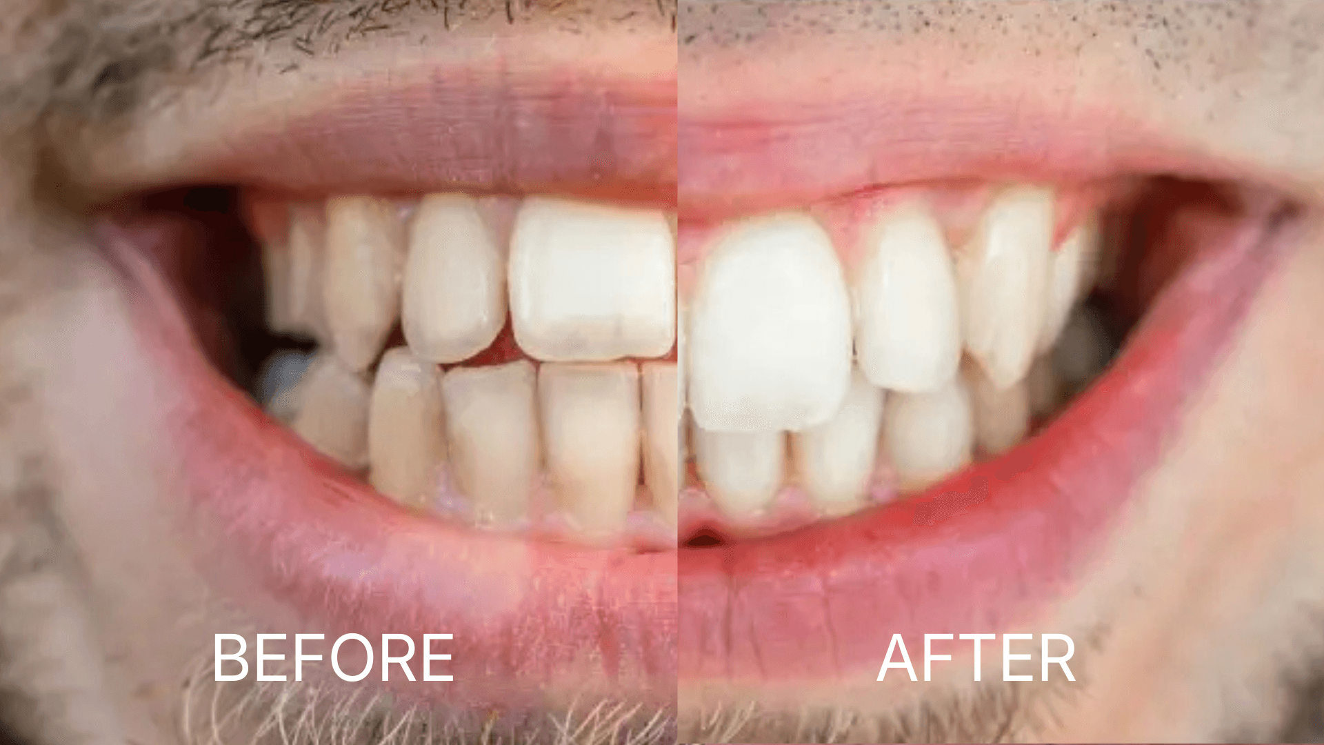 Invisalign