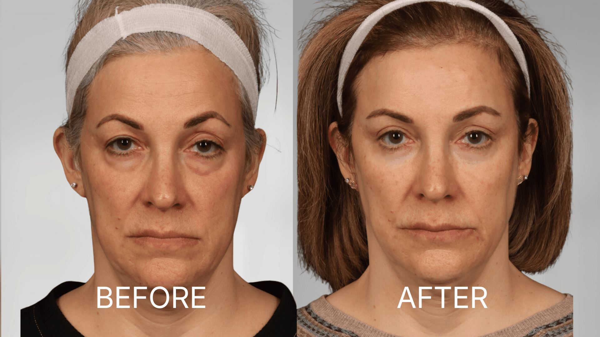 Laser Skin Resurfacing
