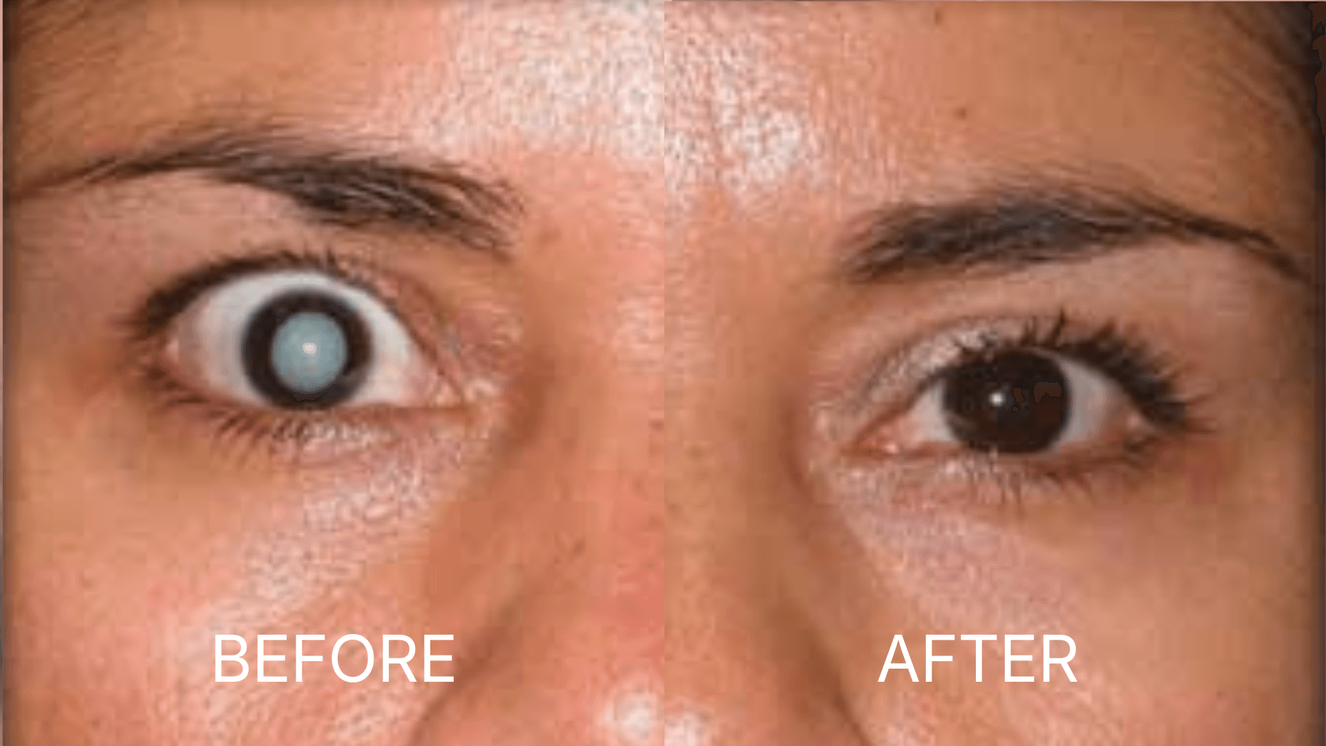 Lens Replacement (RLE)