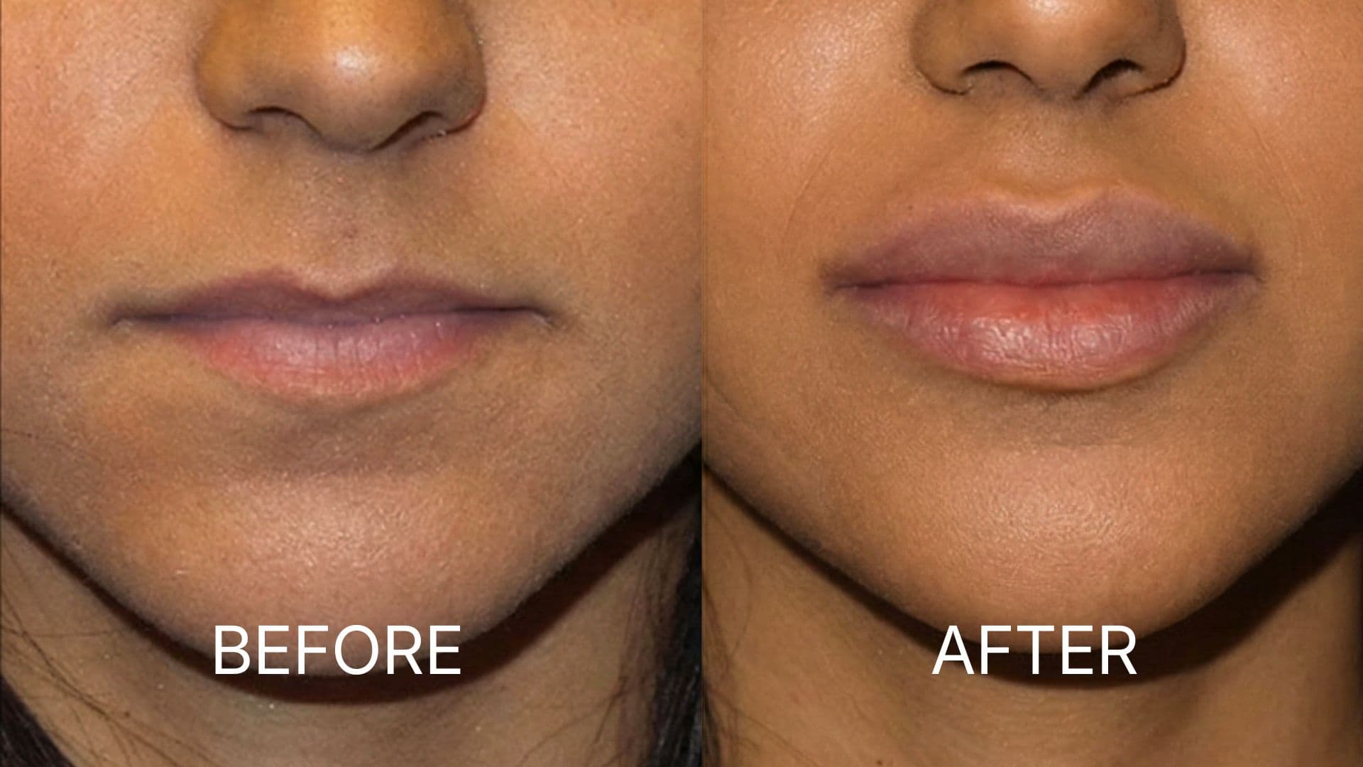 Lip Augmentation