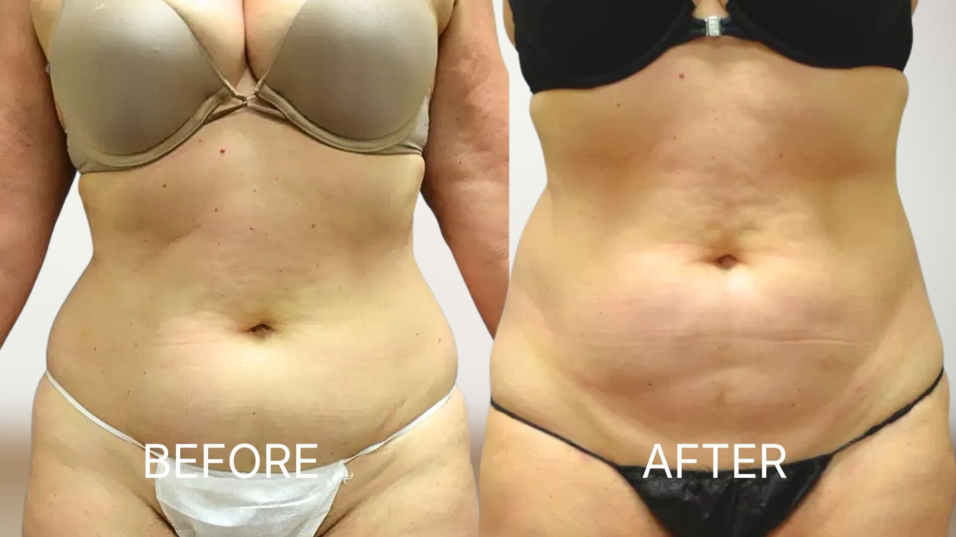 Liposuction