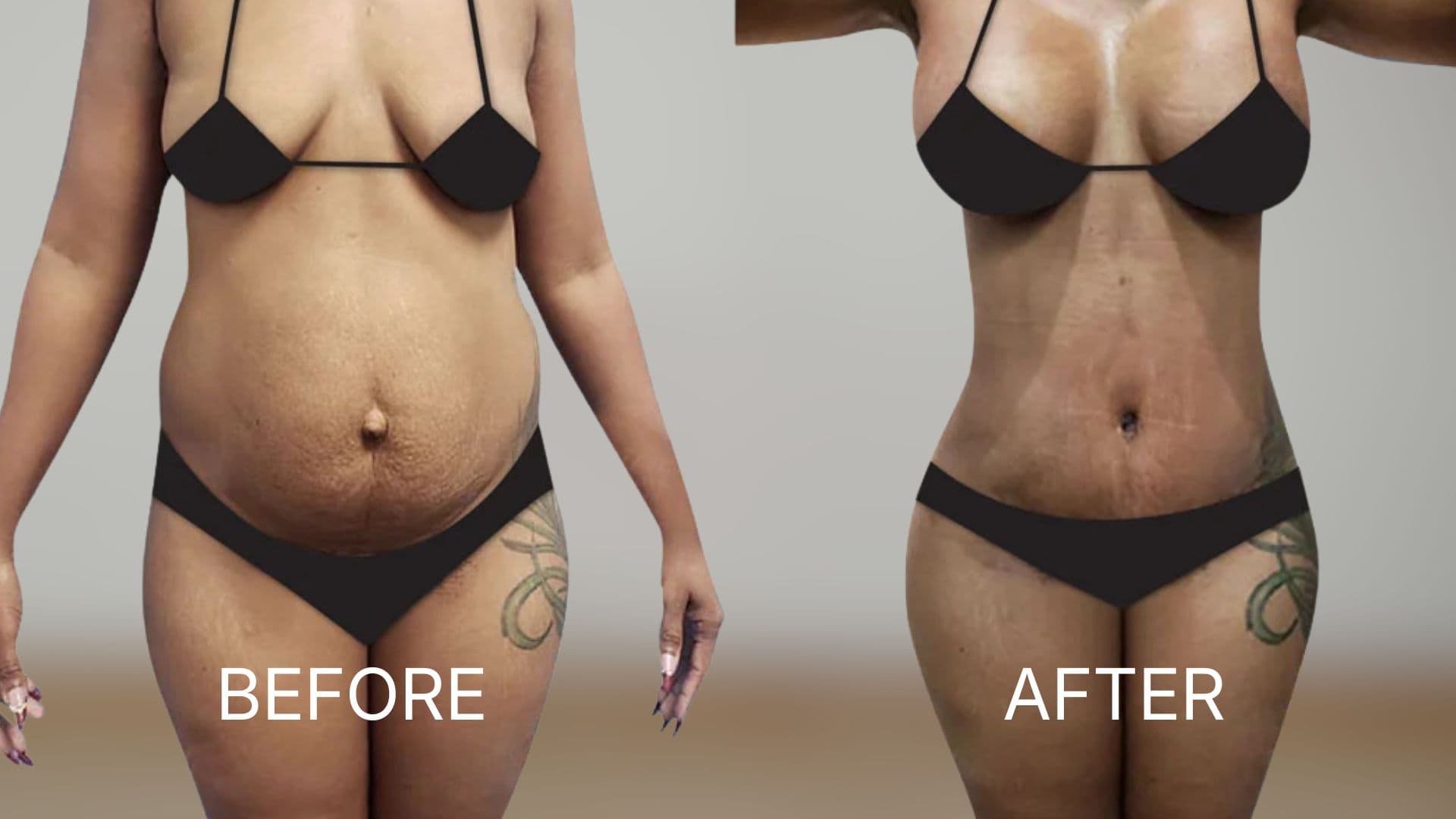 Mommy Makeover