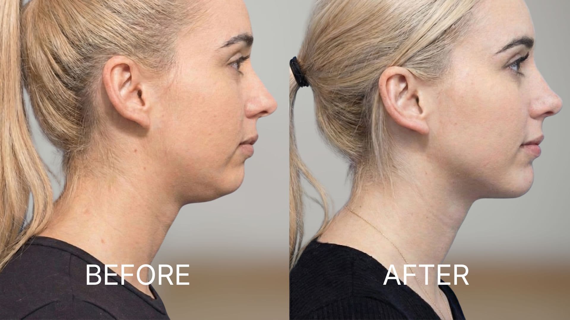 Neck Lift