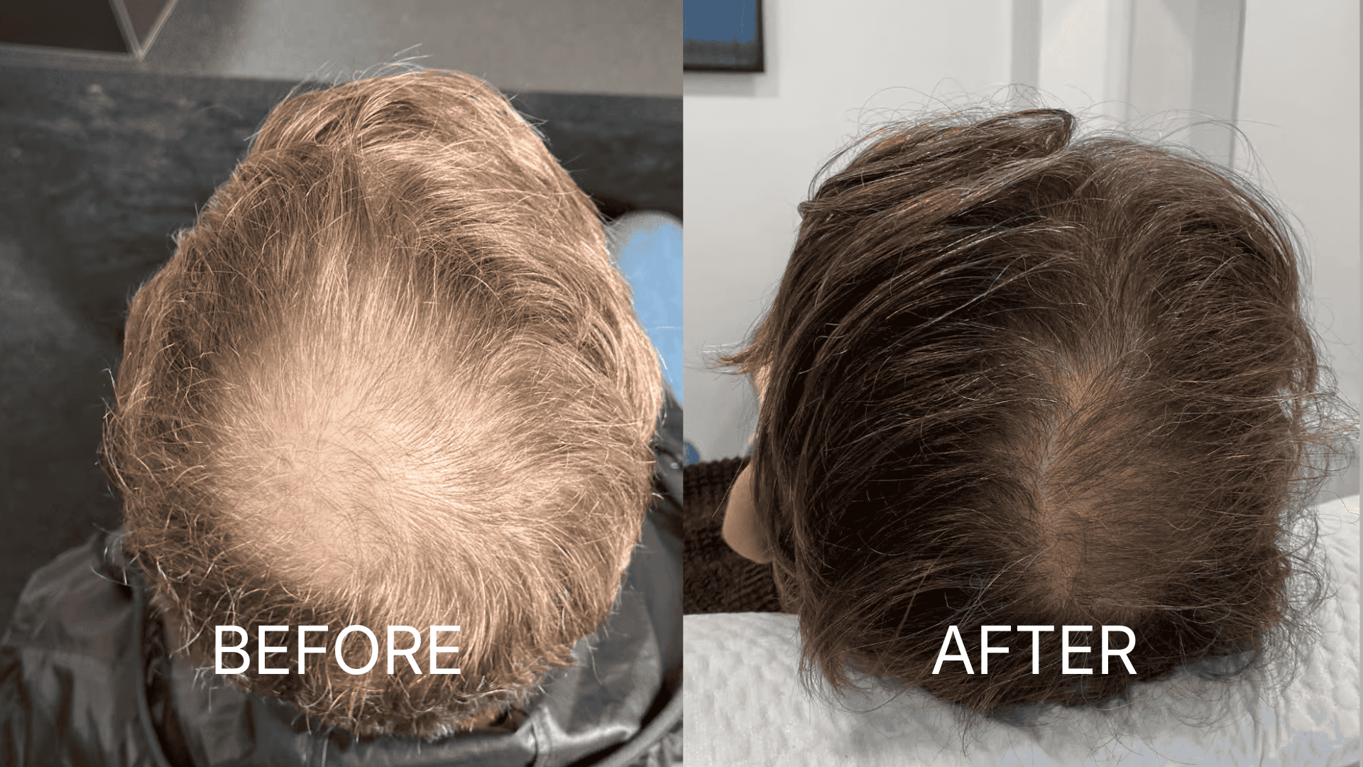 PRP Therapy