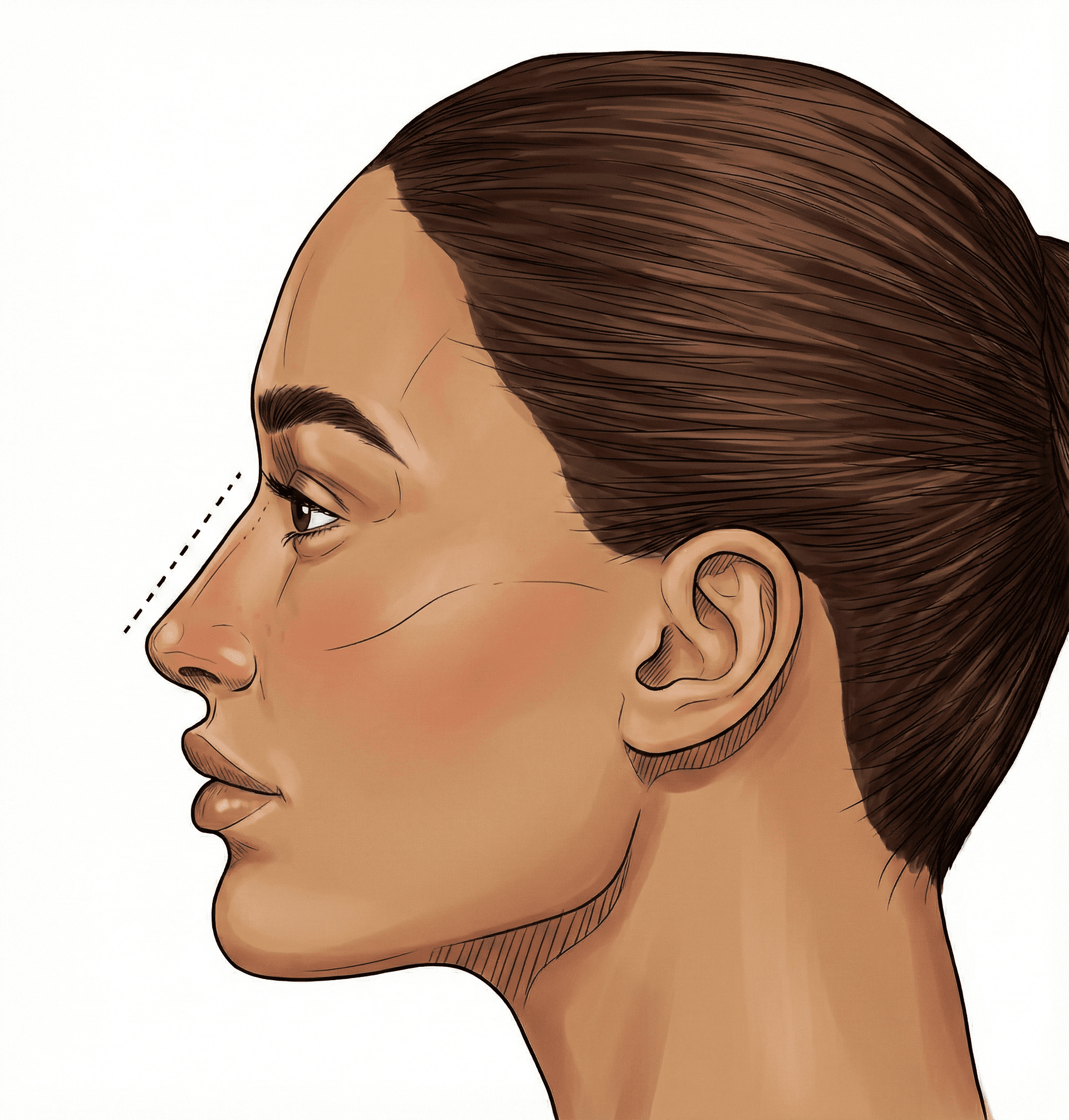 Rhinoplasty (Nose Job)