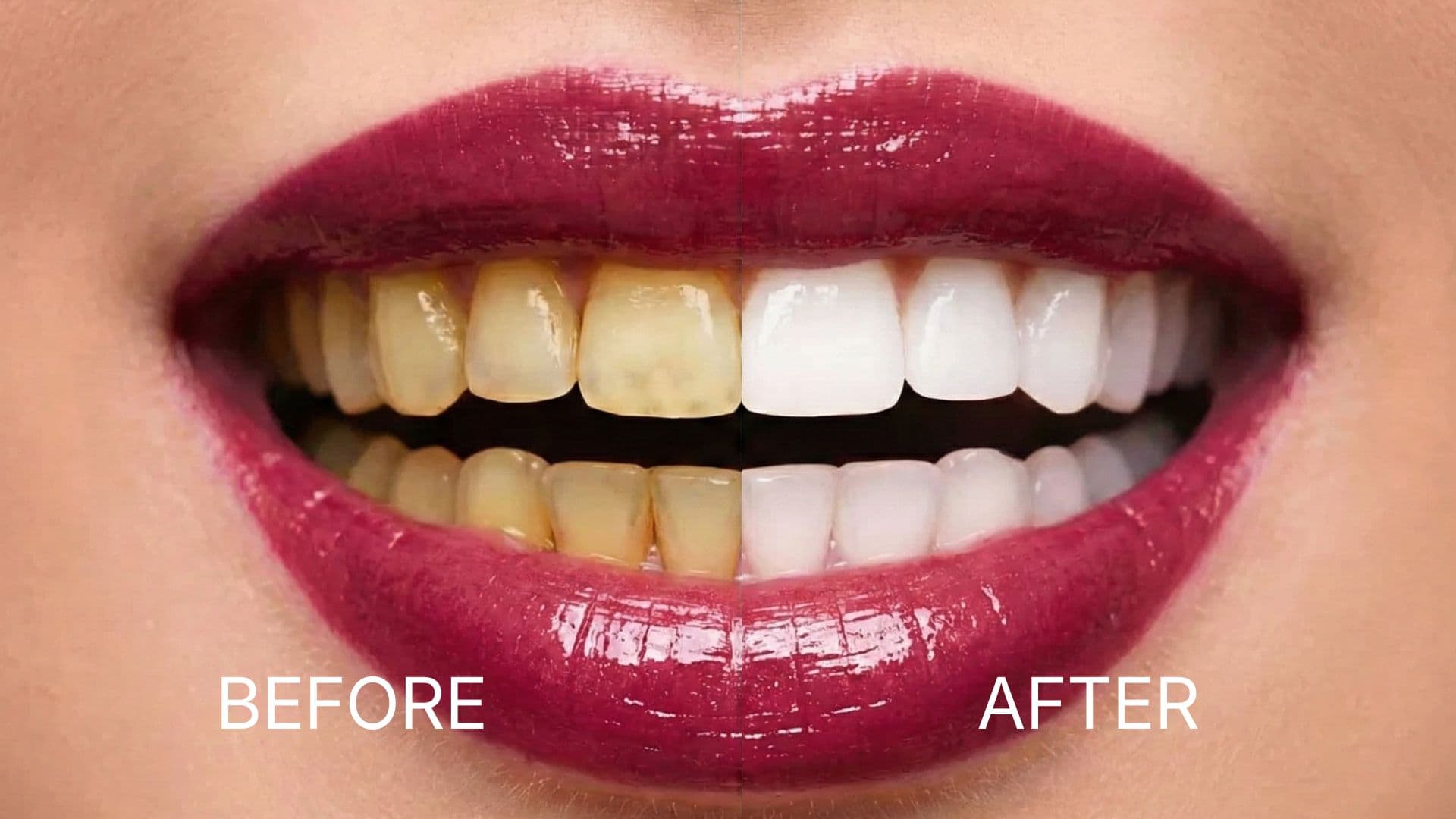 Teeth Whitening