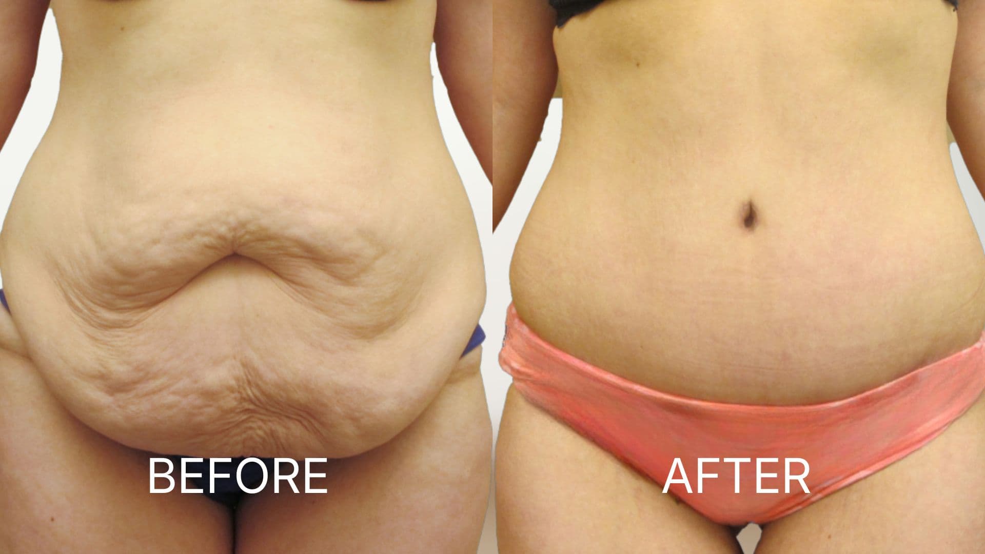 Tummy Tuck before and after