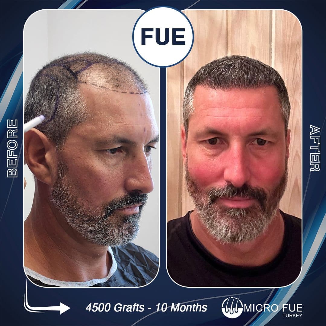 Hair Transplant Taksim | TESLA TRAVEL ISTANBUL