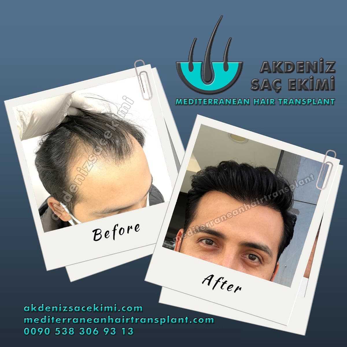 Akdeniz Antalya Saç Ekimi - Hair Transplant Antalya