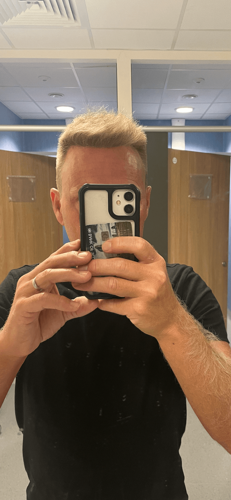 Akdeniz Antalya Saç Ekimi - Hair Transplant Antalya