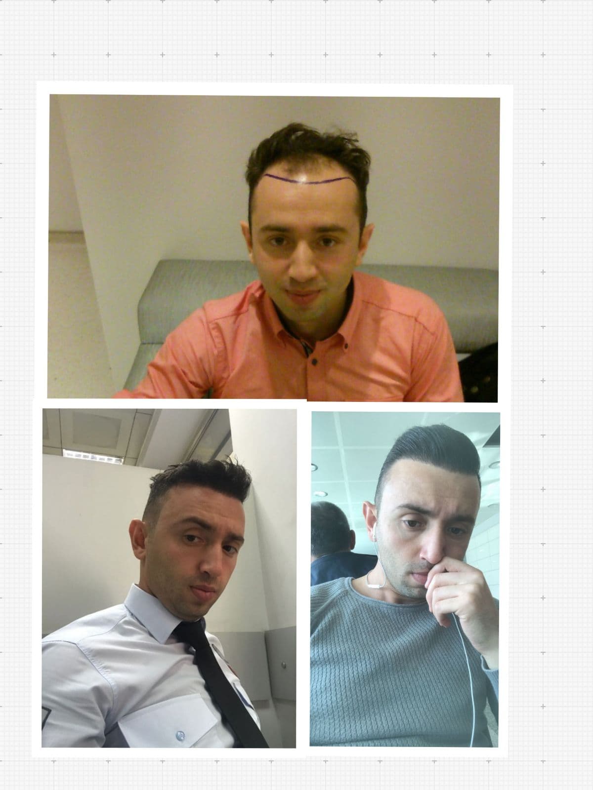 İstanbul saç ekimi merkezi