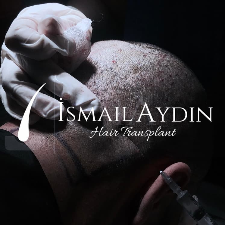 İstanbul saç ekimi merkezi