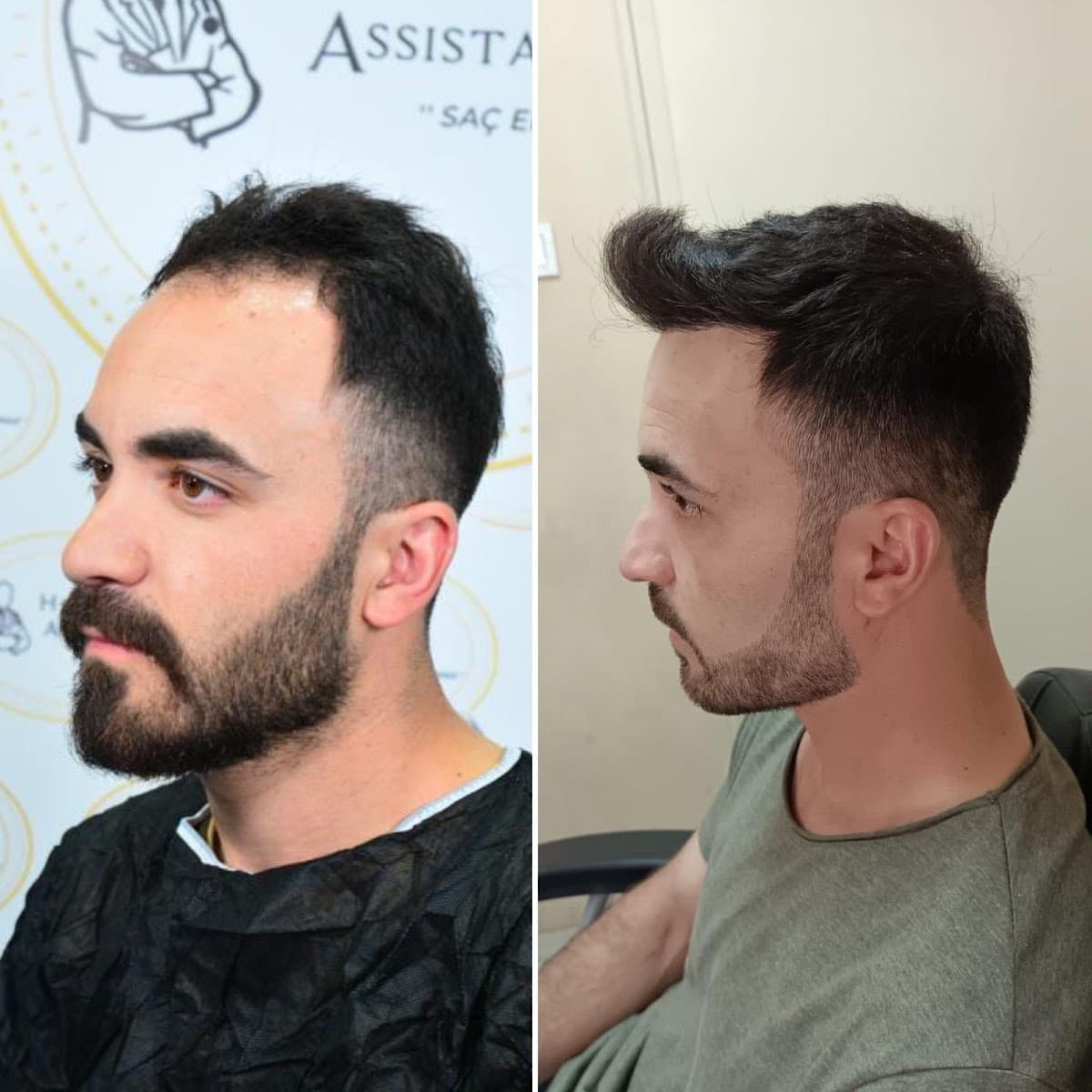 Hasan Demir Saç Ekimi Ankara