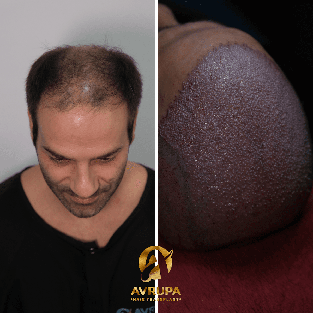Avrupa Hair Transplant