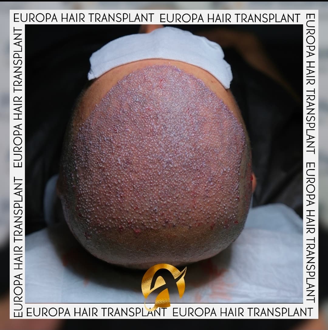 Avrupa Hair Transplant