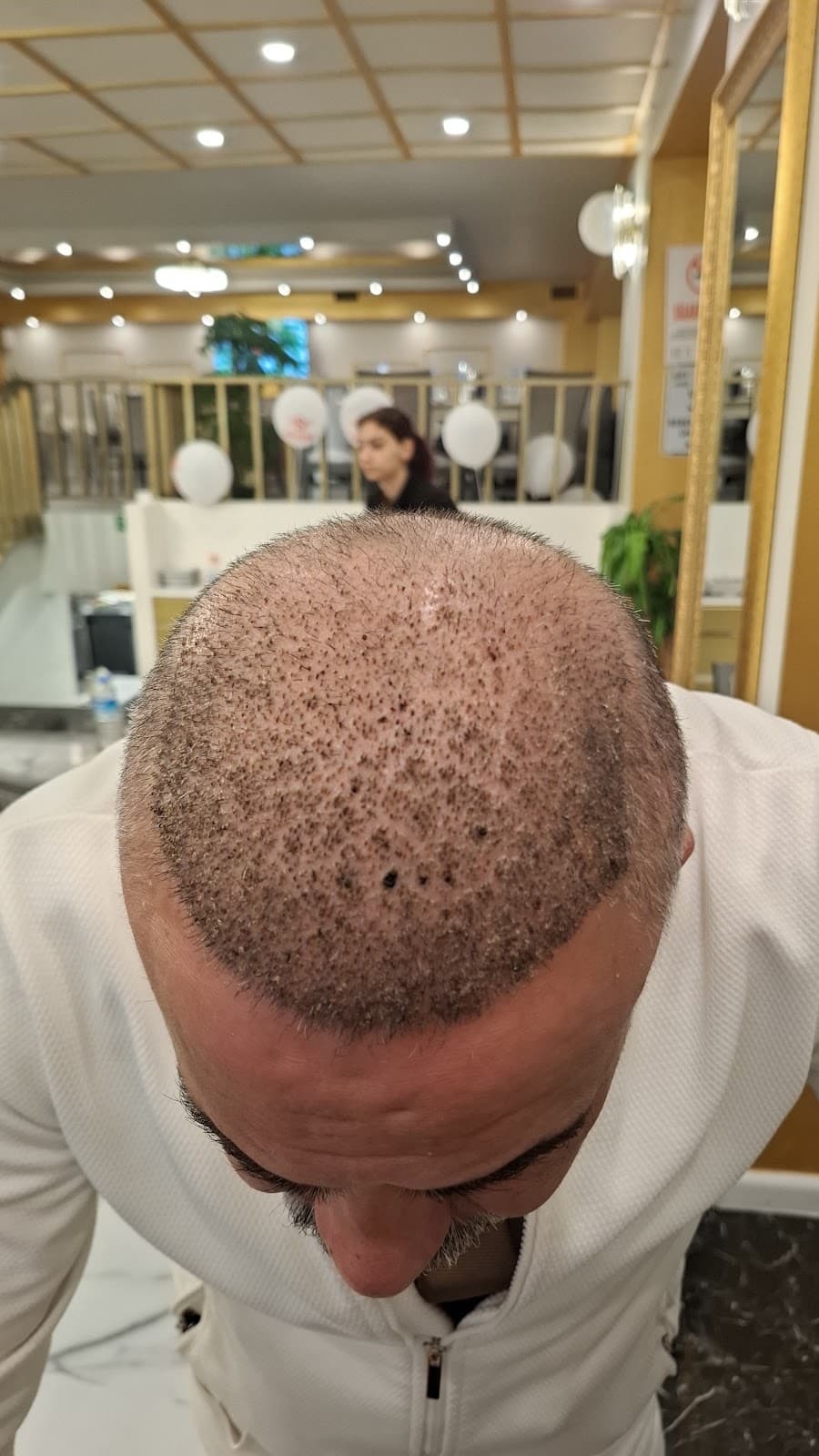 Vialux Hair Transplant