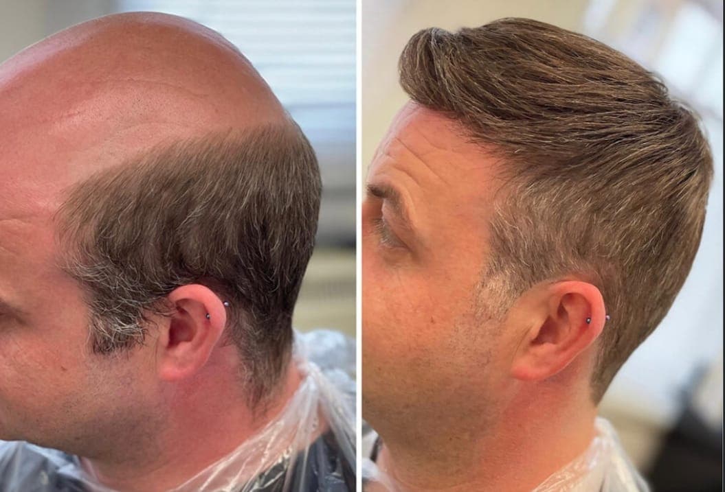 VOONHAİR PROTEZ SAÇ ANKARA