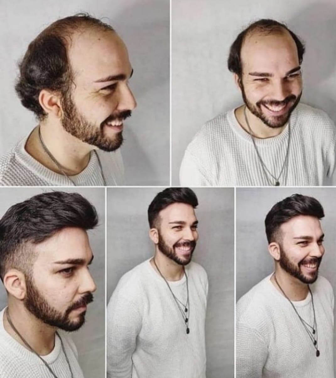 VOONHAİR PROTEZ SAÇ ANKARA