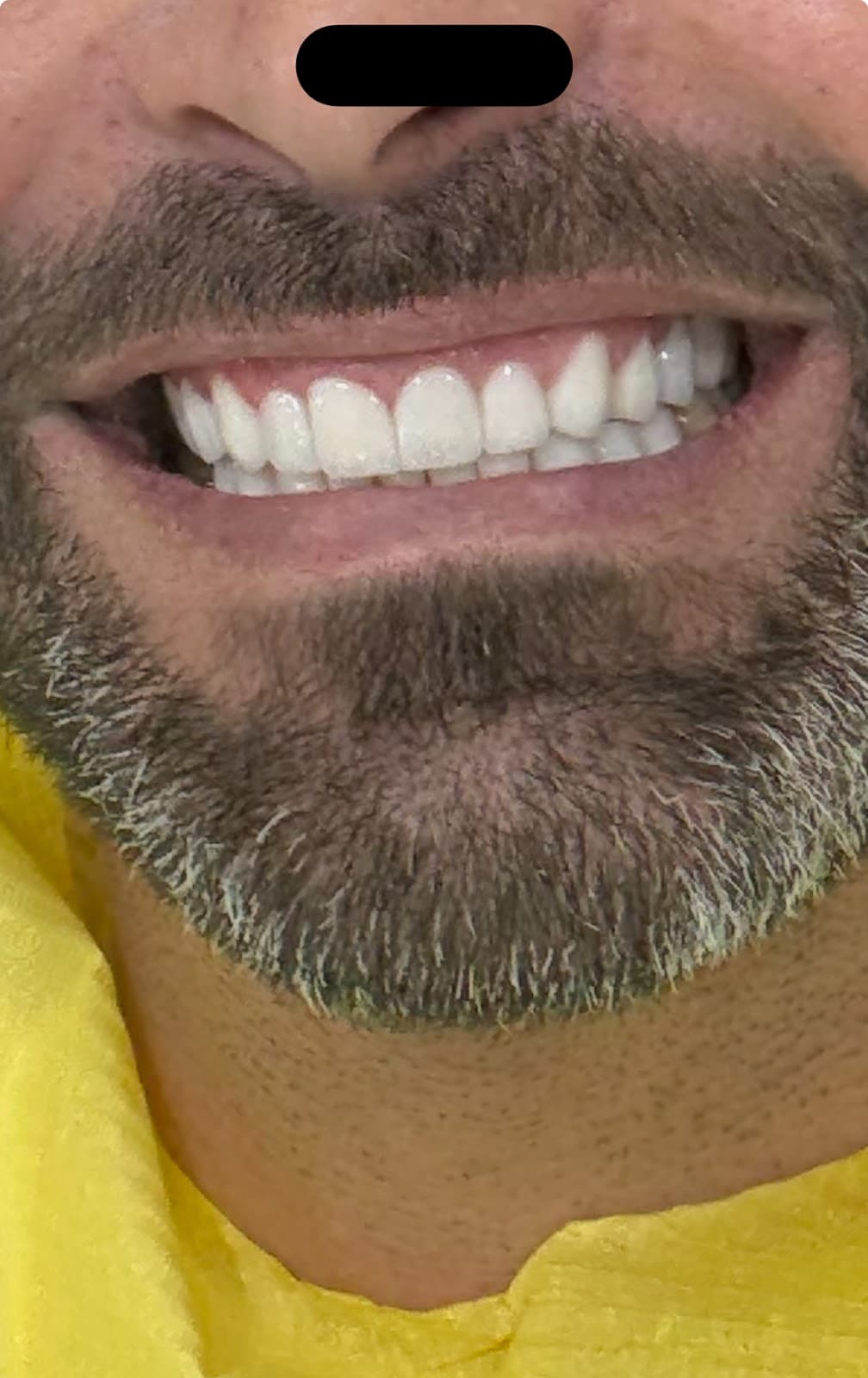 The best dental clinic in turkey | dental implants in turkey | Veneers | All on 4 | Zirconium crowns | ALL ON X clinic