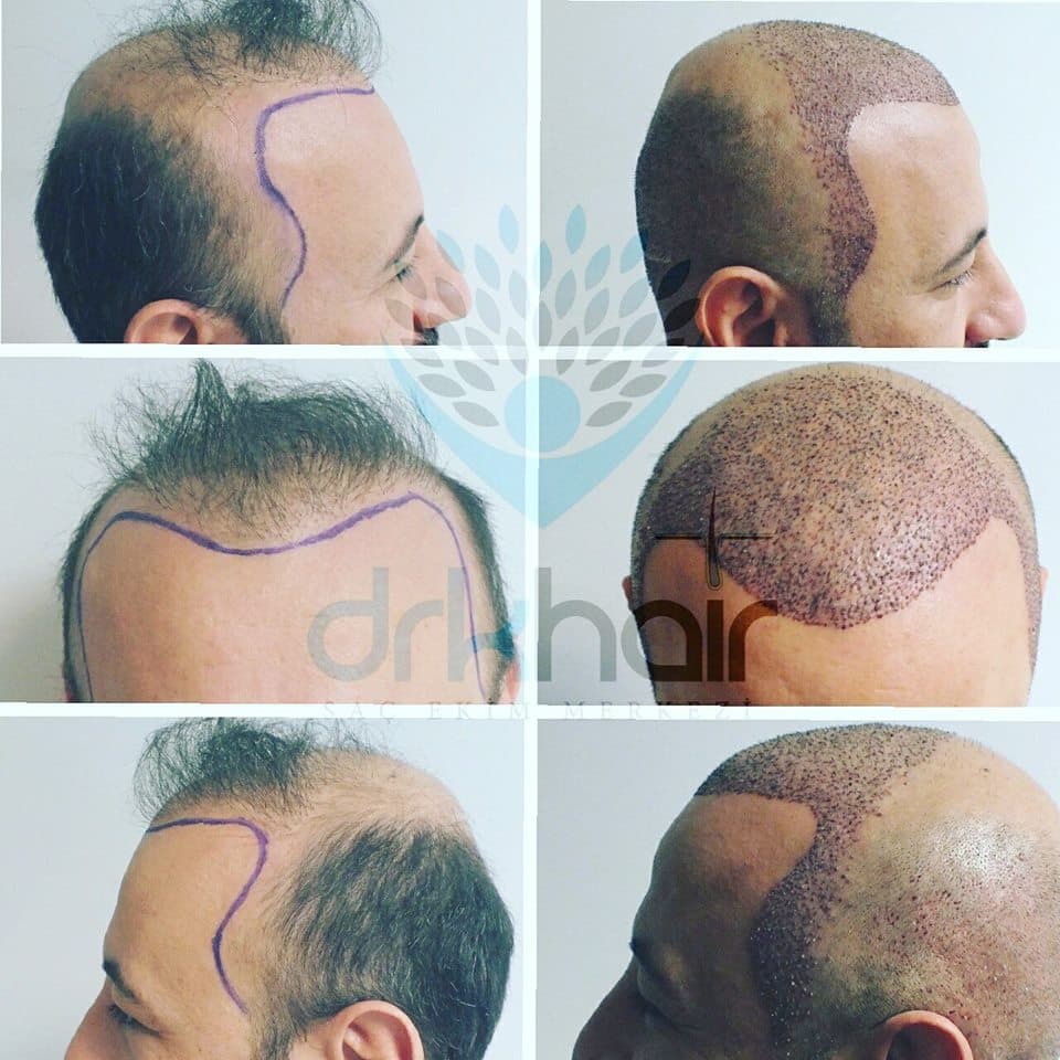 DRKHAIR Saç Ekim Merkezi Antalya