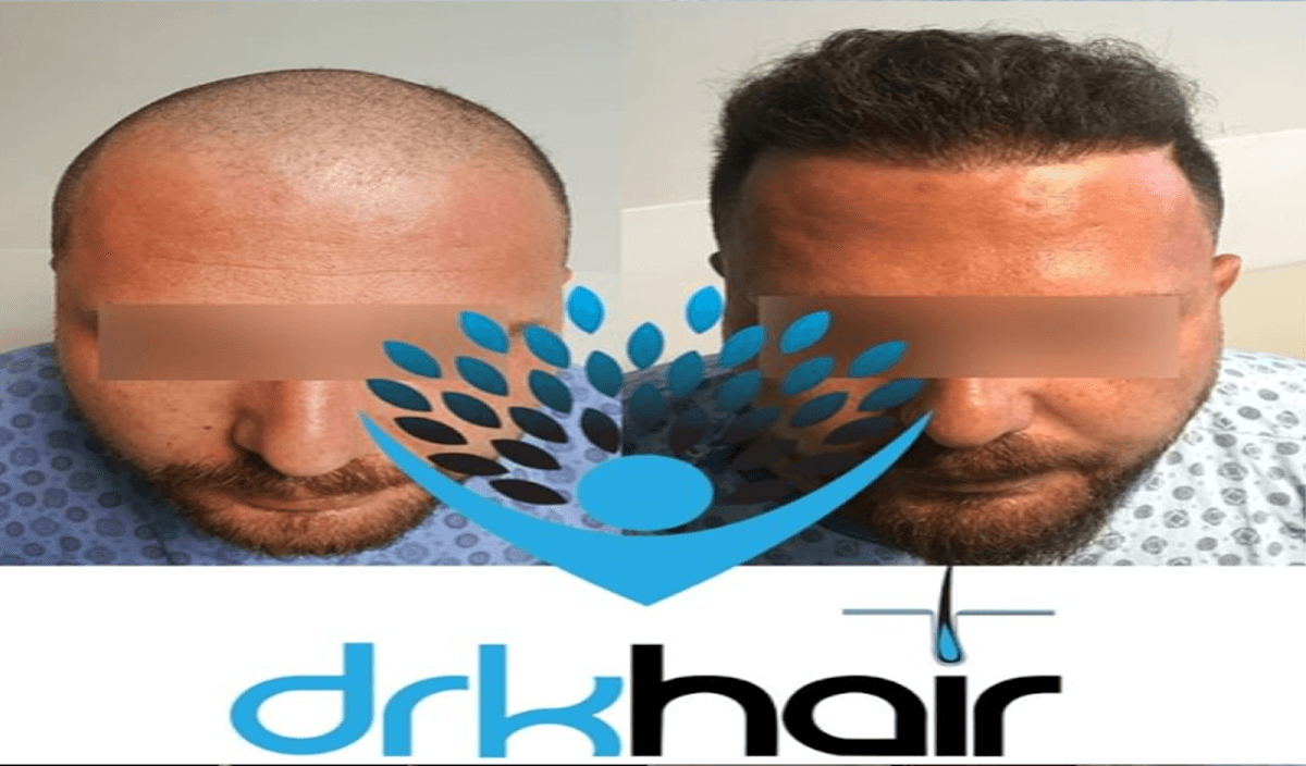 DRKHAIR Saç Ekim Merkezi Antalya
