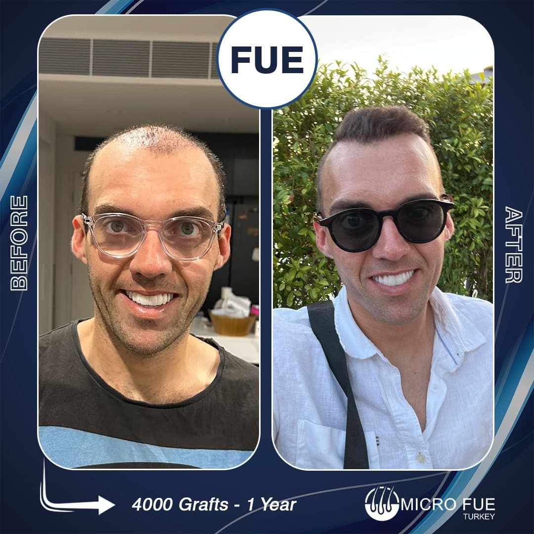 Micro fue Turkey | Hair Transplant